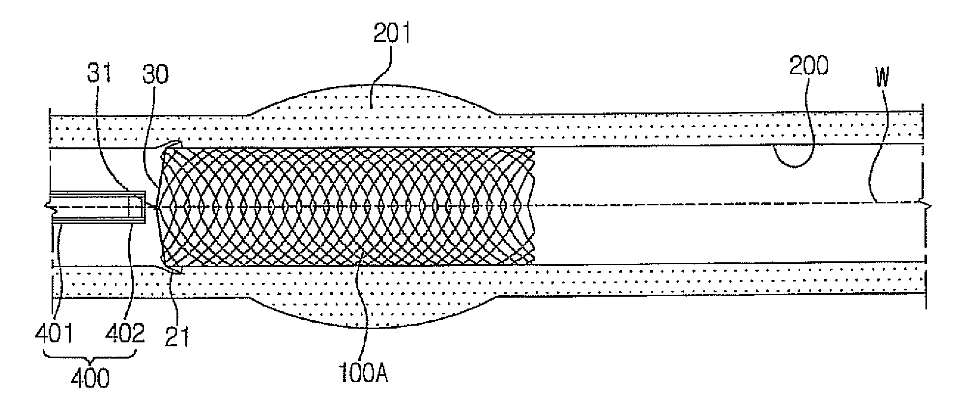 Stent for prostatic urethra expansion