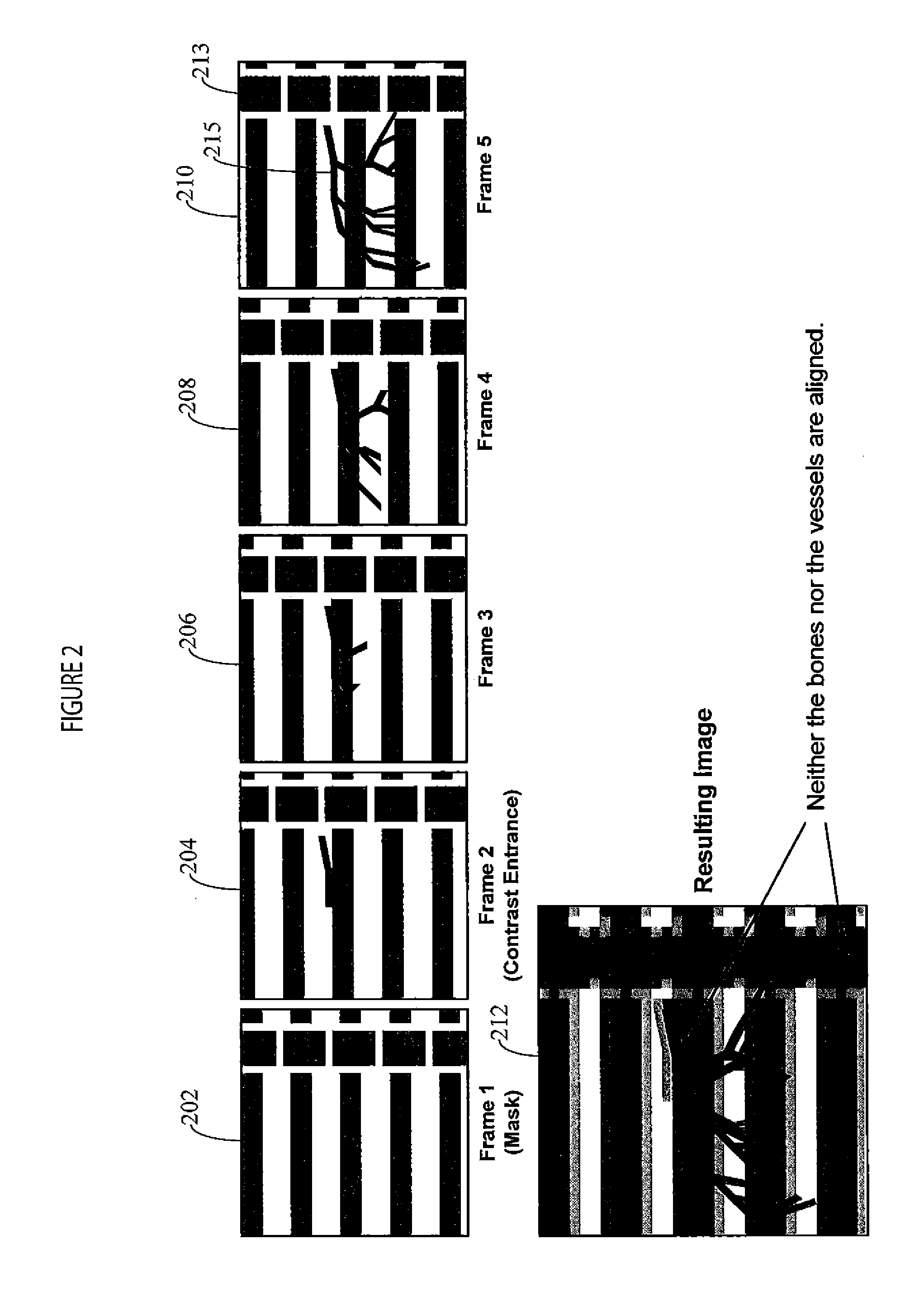 Digital subtraction angiography (DSA) motion compensated imaging system