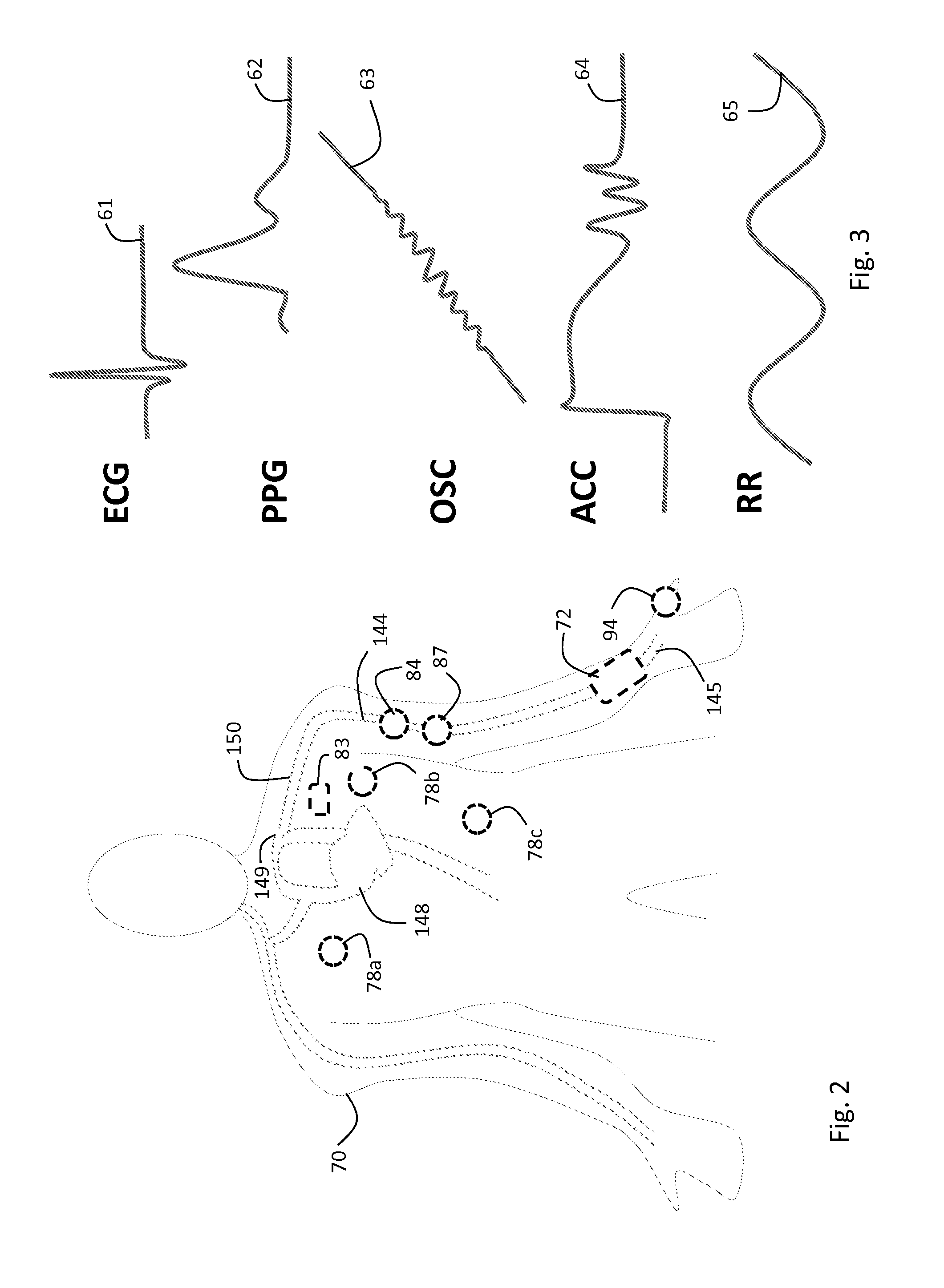 Body-worn vital sign monitor