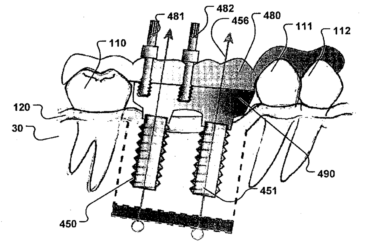 Computer implemented planning and providing of mass customized bone structure