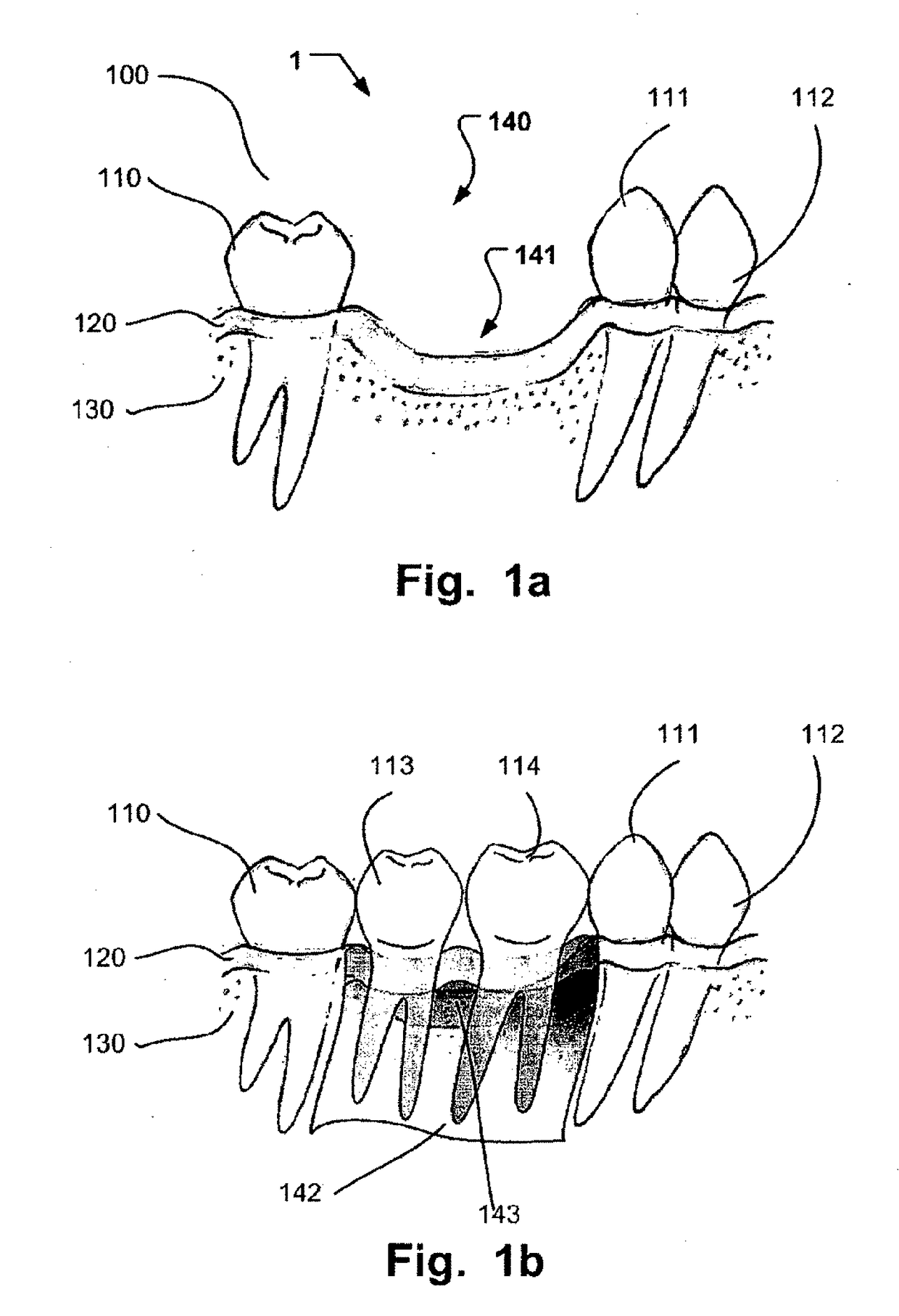 Computer implemented planning and providing of mass customized bone structure