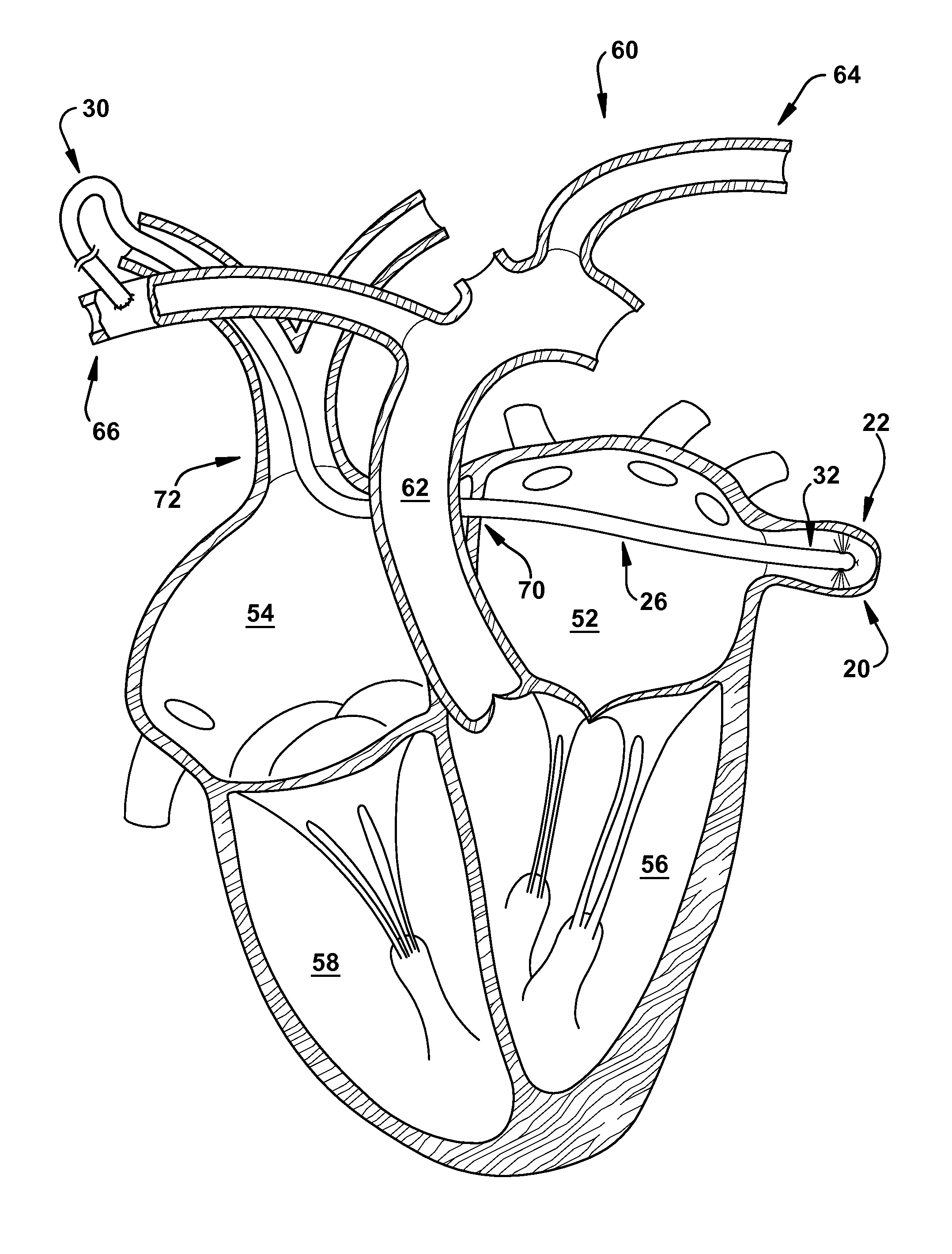 Method for increasing blood flow in or about a cardiac or other vascular or prosthetic structure to prevent thrombosis