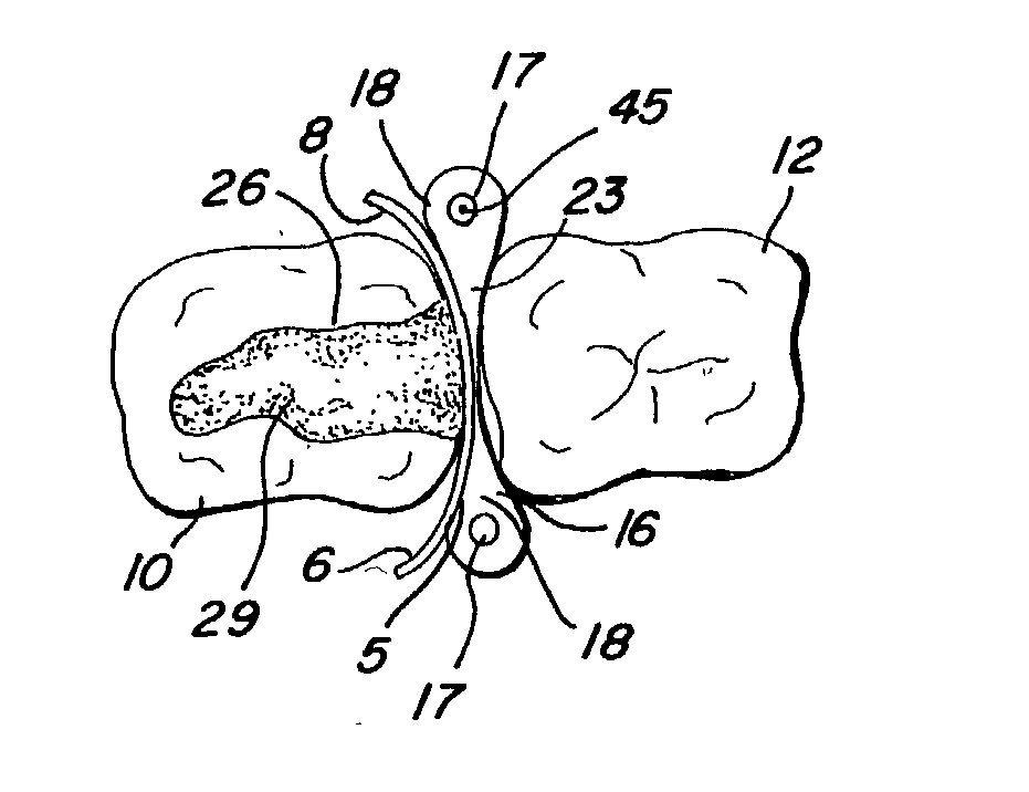 Interproximal matrix with elastomeric wedge