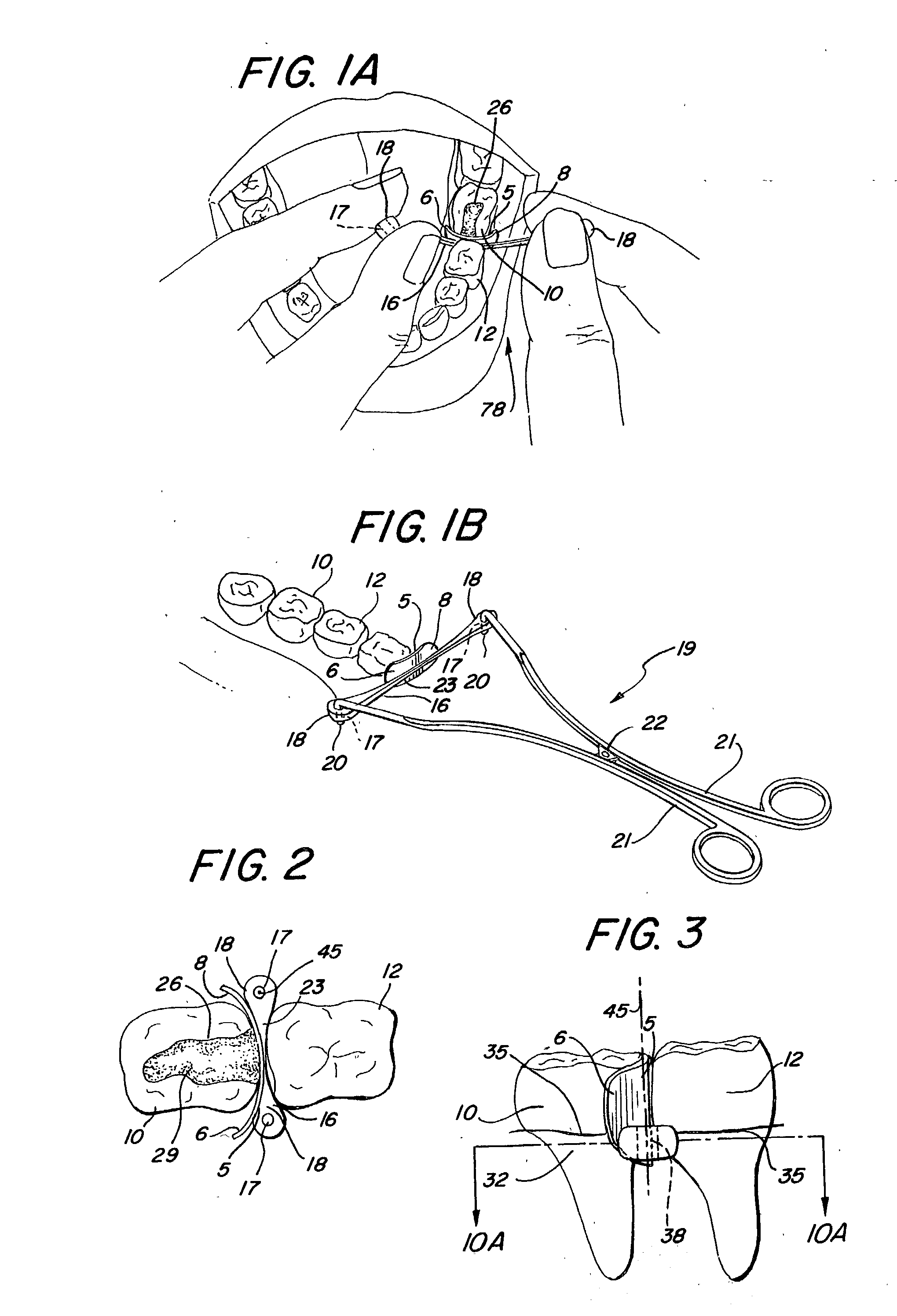 Interproximal matrix with elastomeric wedge