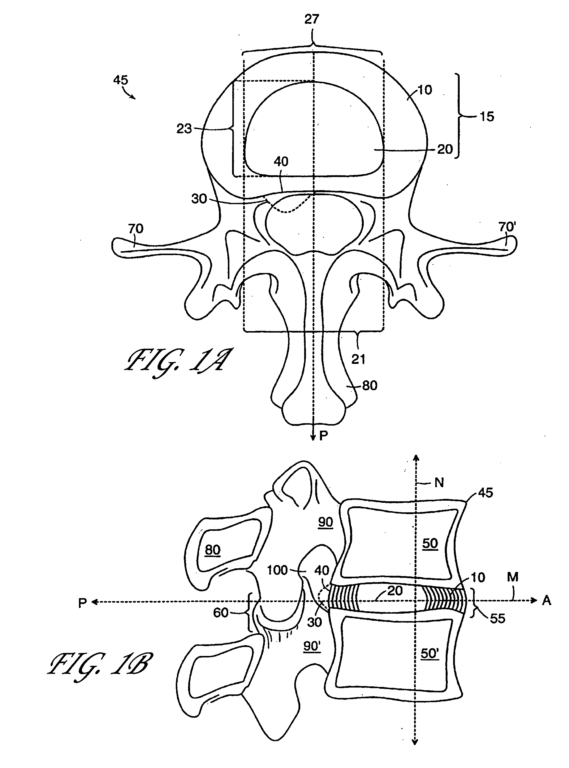 Intervertebral anulus and nucleus augmentation