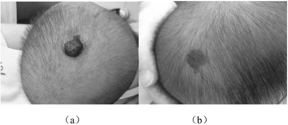 Timolol external preparation for treating hemangioma