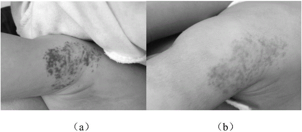 Timolol external preparation for treating hemangioma