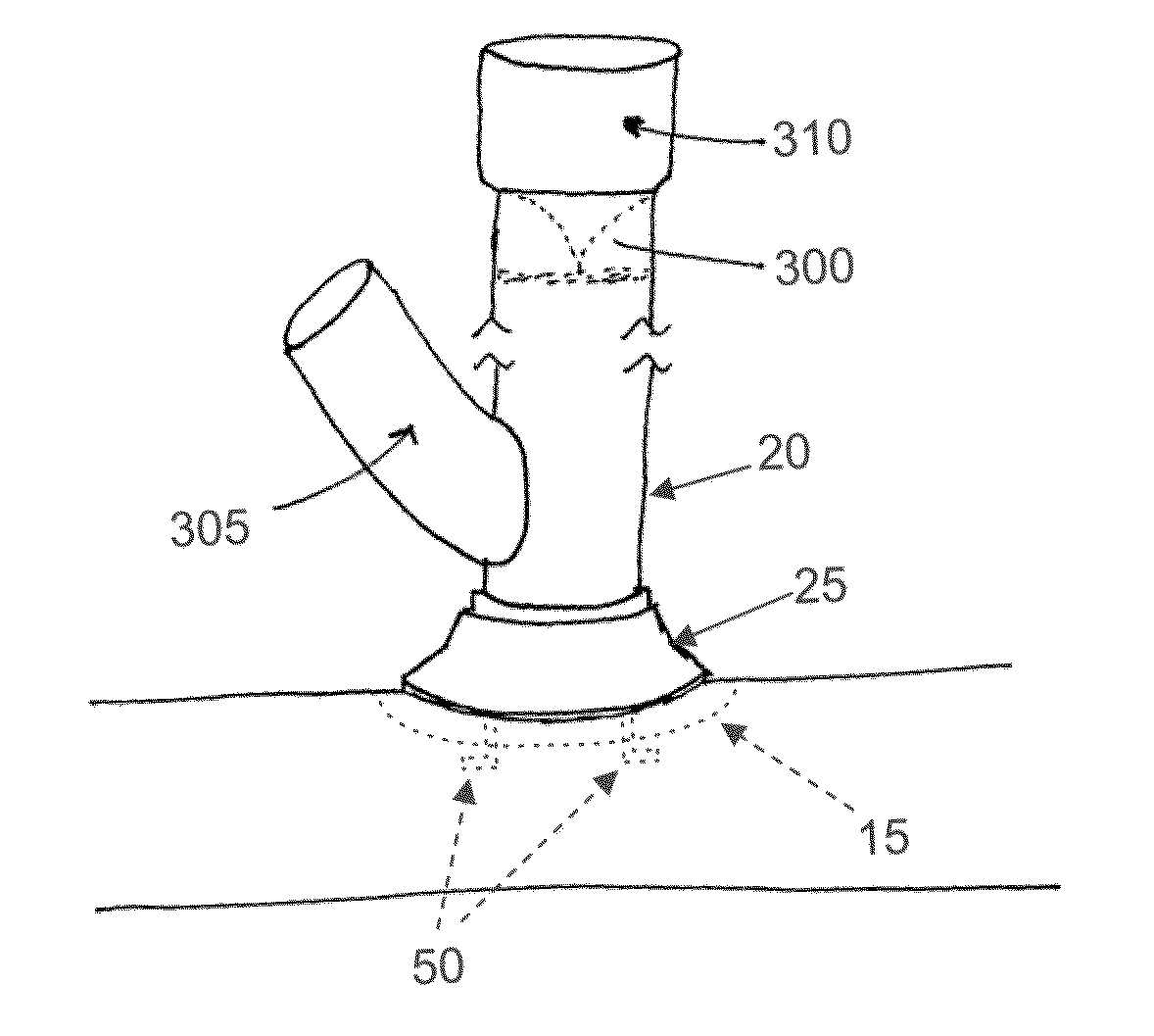 Method and apparatus for effecting a minimally invasive distal anastomosis for an aortic valve bypass