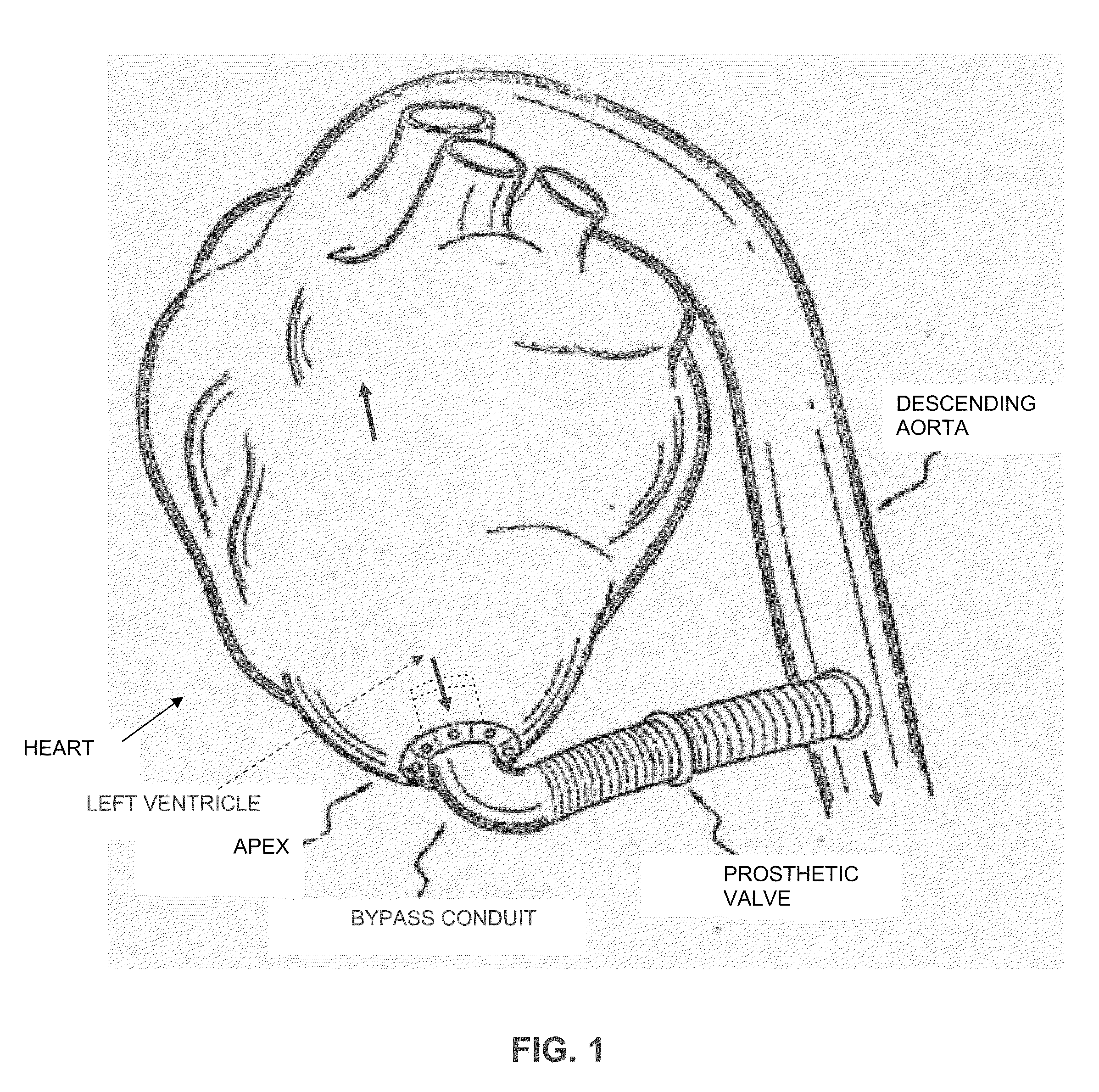 Method and apparatus for effecting a minimally invasive distal anastomosis for an aortic valve bypass