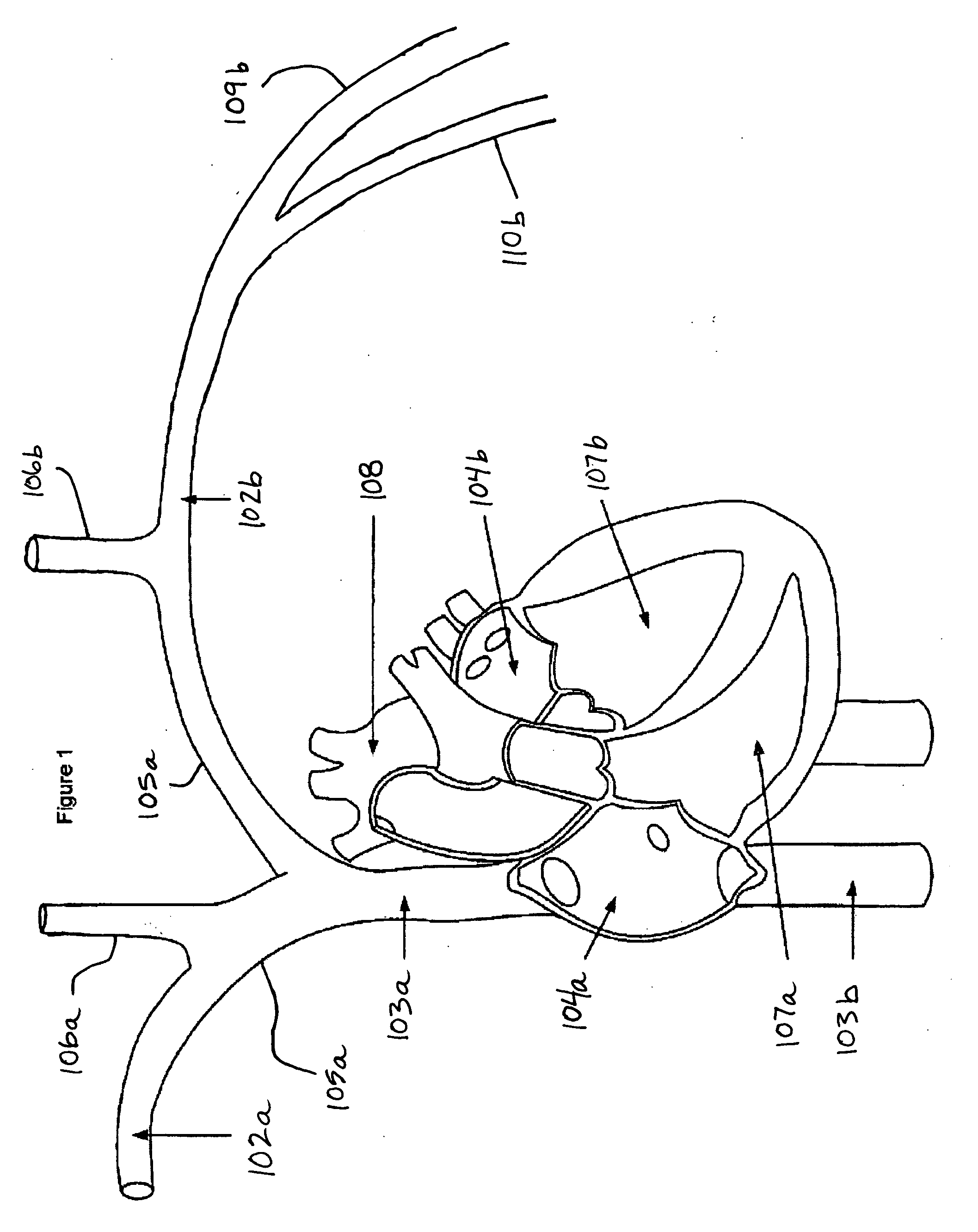 Intravascular implantable device having superior anchoring arrangement