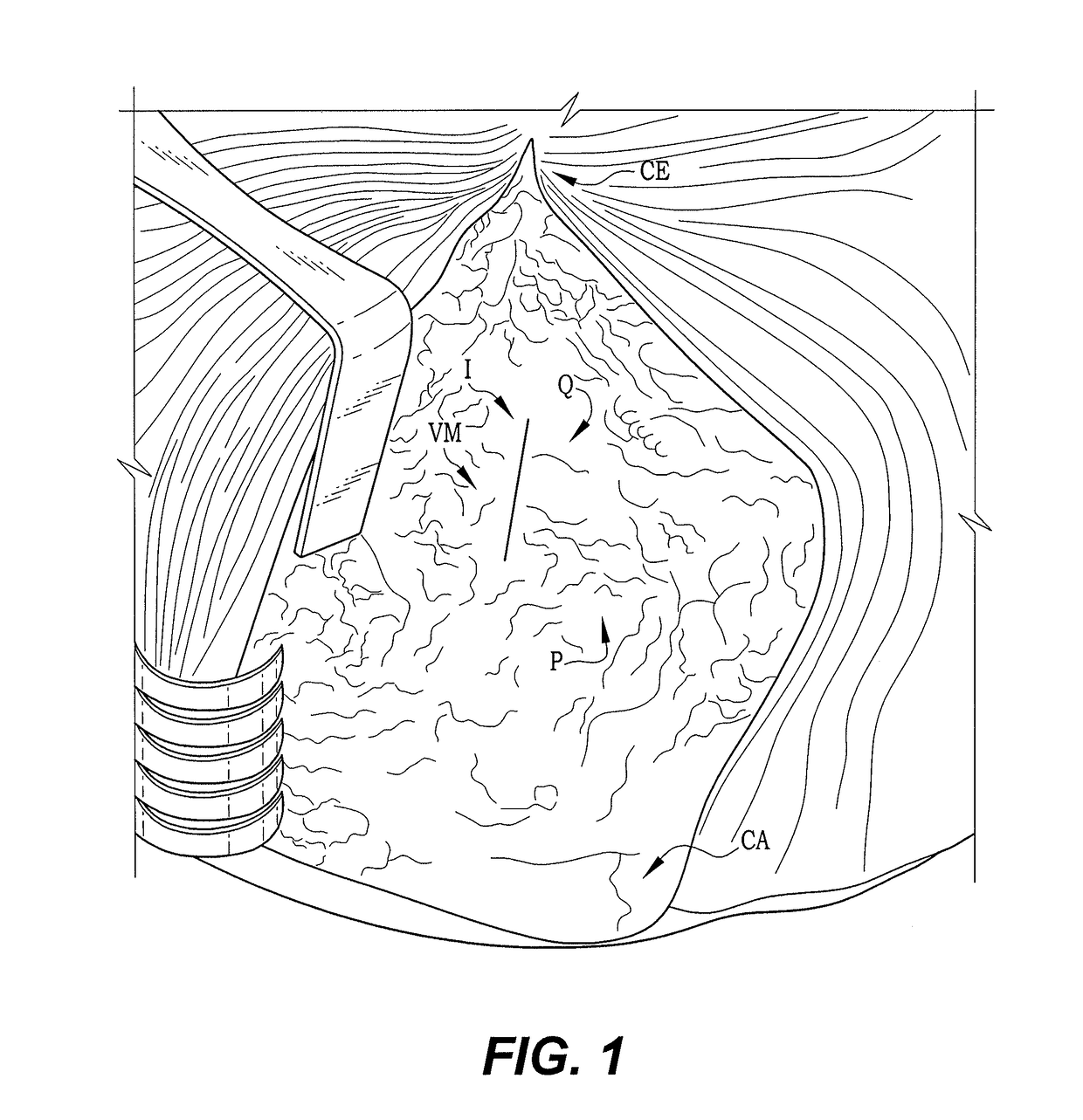 Method of performing a modified intervastus approach in total knee arthroplasty procedures