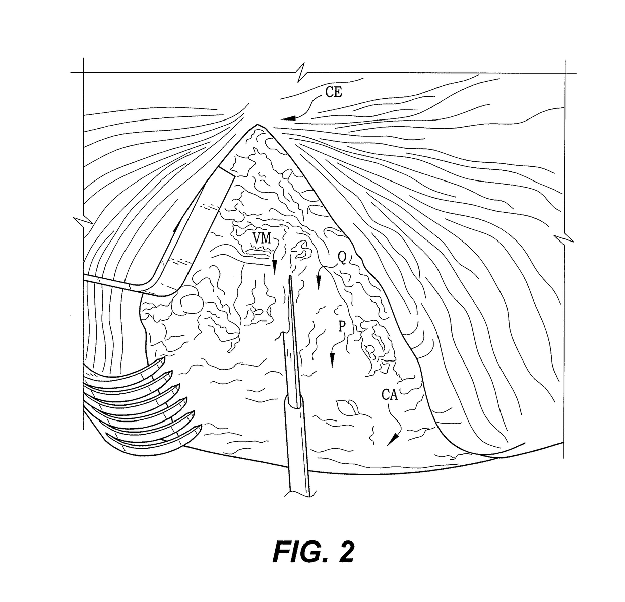 Method of performing a modified intervastus approach in total knee arthroplasty procedures