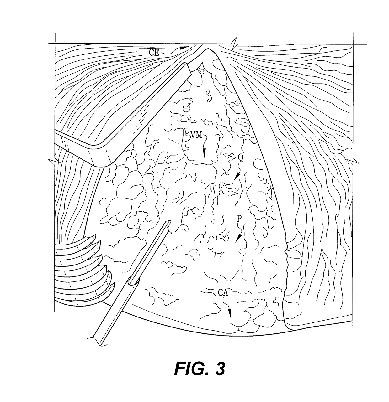 Method of performing a modified intervastus approach in total knee arthroplasty procedures