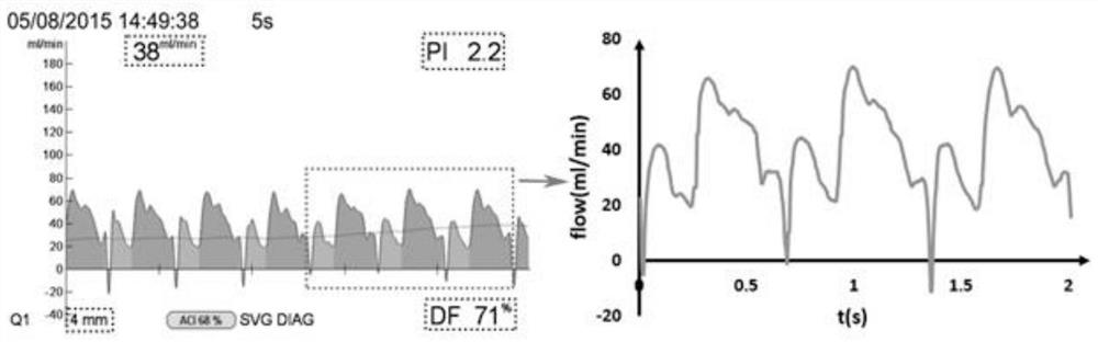 A method for establishing a model to predict the permeability of graft vessels in heart bypass surgery based on hemodynamic models