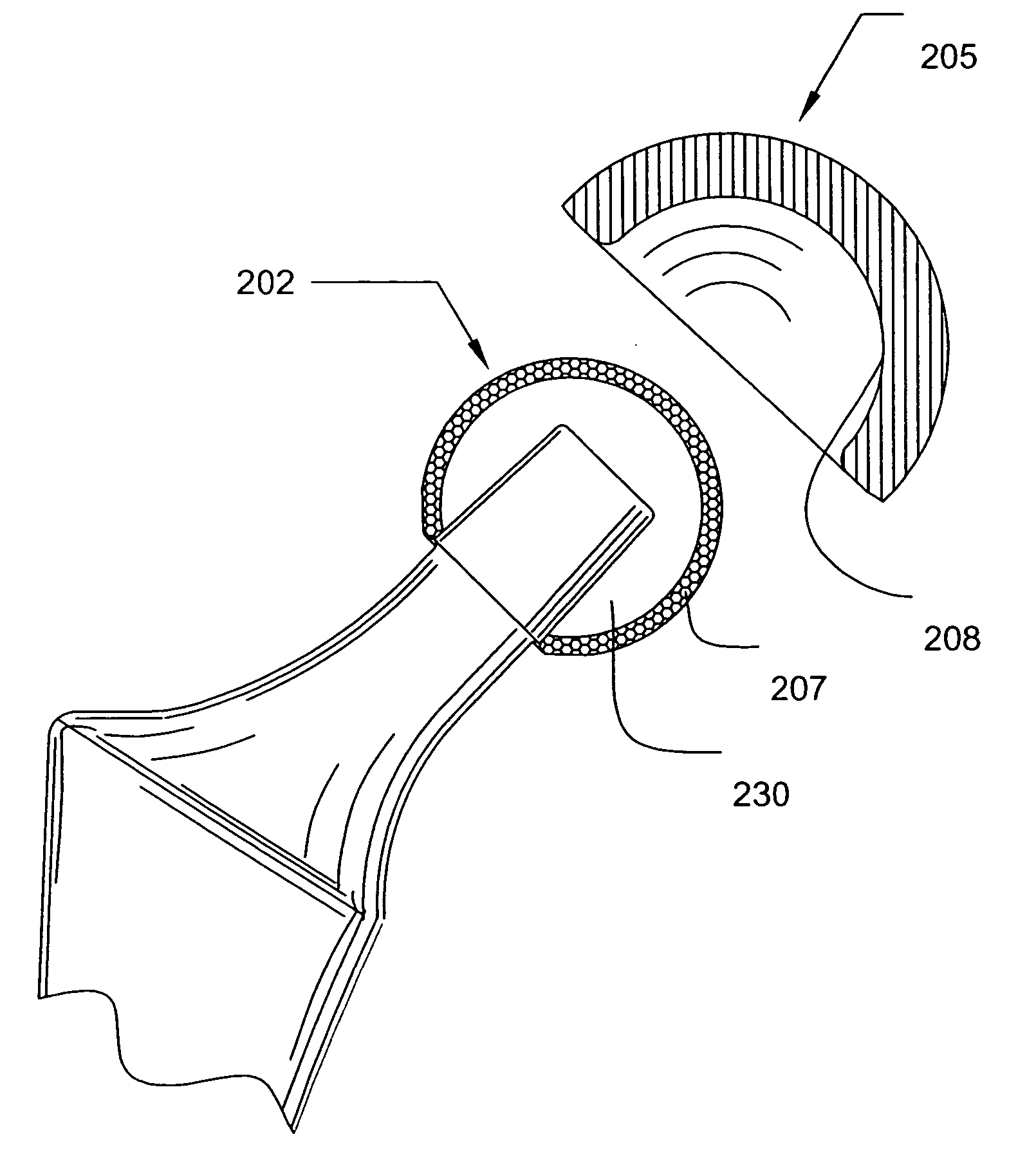 Prosthetic joint component having at least one sintered polycrystalline diamond compact articulation surface and substrate surface topographical features in said polycrystalline diamond compact