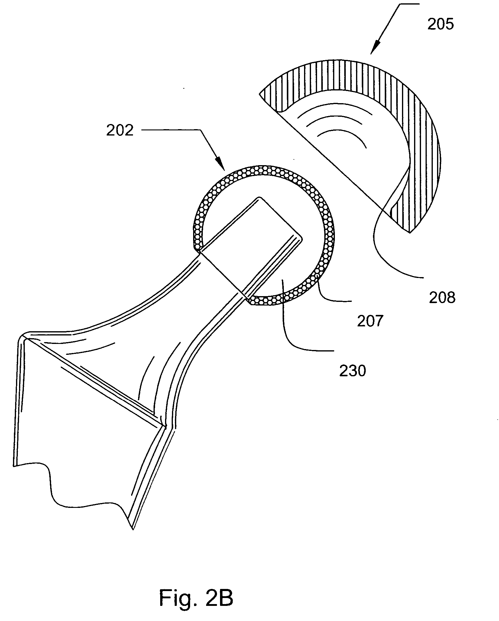 Prosthetic joint component having at least one sintered polycrystalline diamond compact articulation surface and substrate surface topographical features in said polycrystalline diamond compact