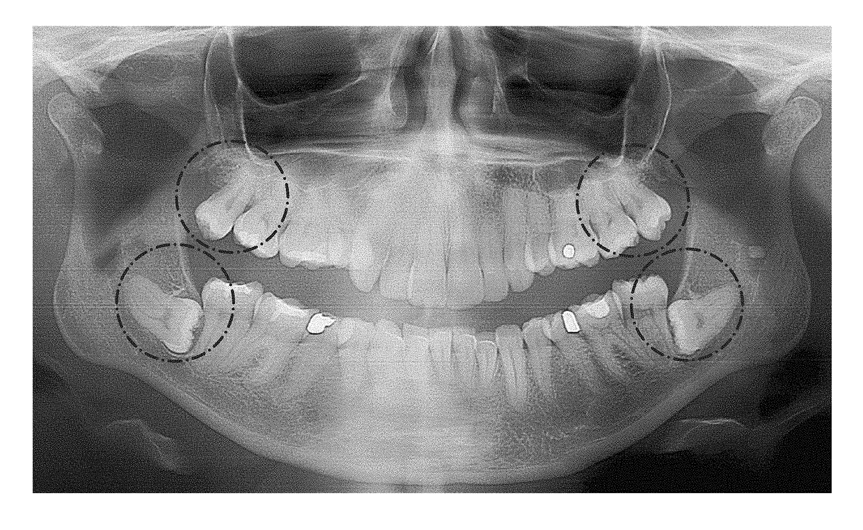 Therapeutic Tooth Bud Ablation