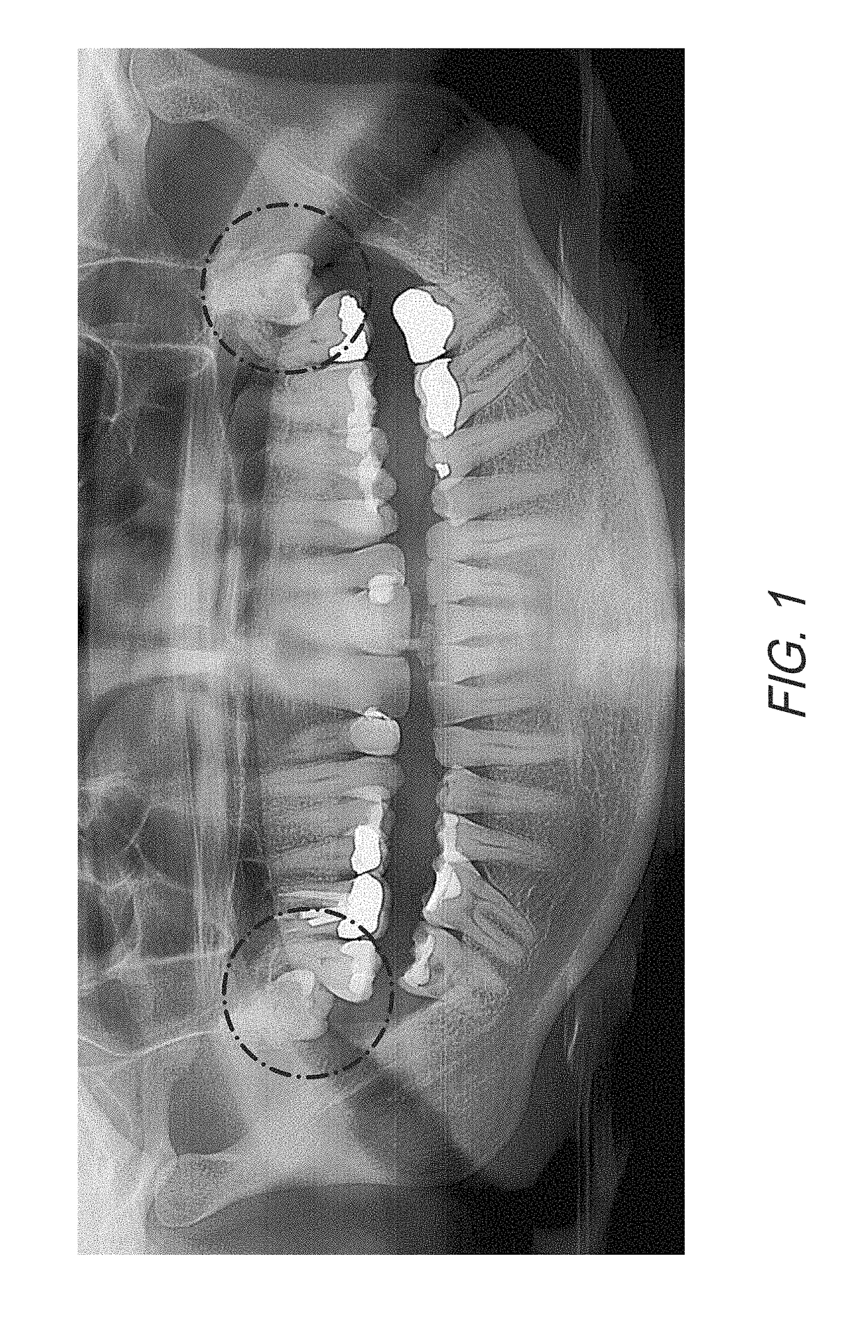 Therapeutic Tooth Bud Ablation