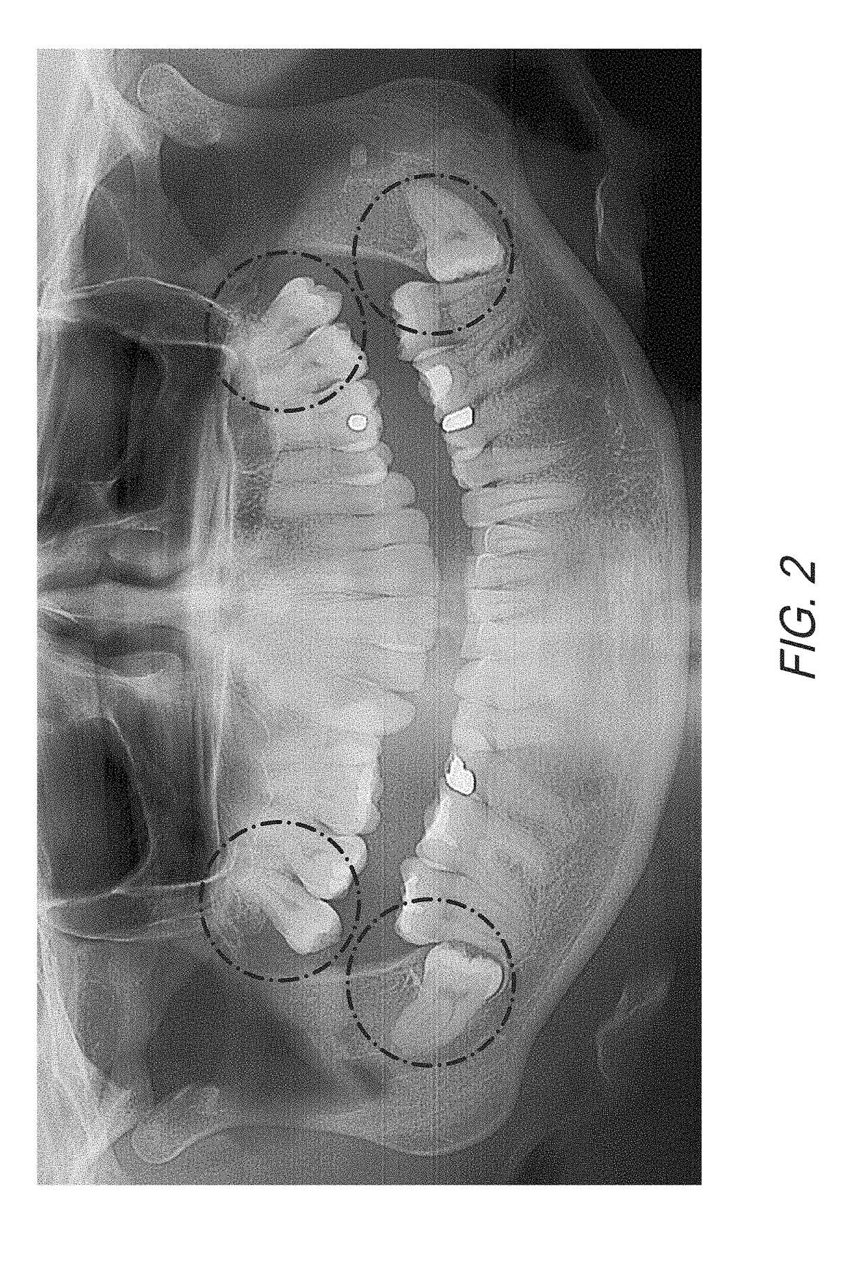 Therapeutic Tooth Bud Ablation