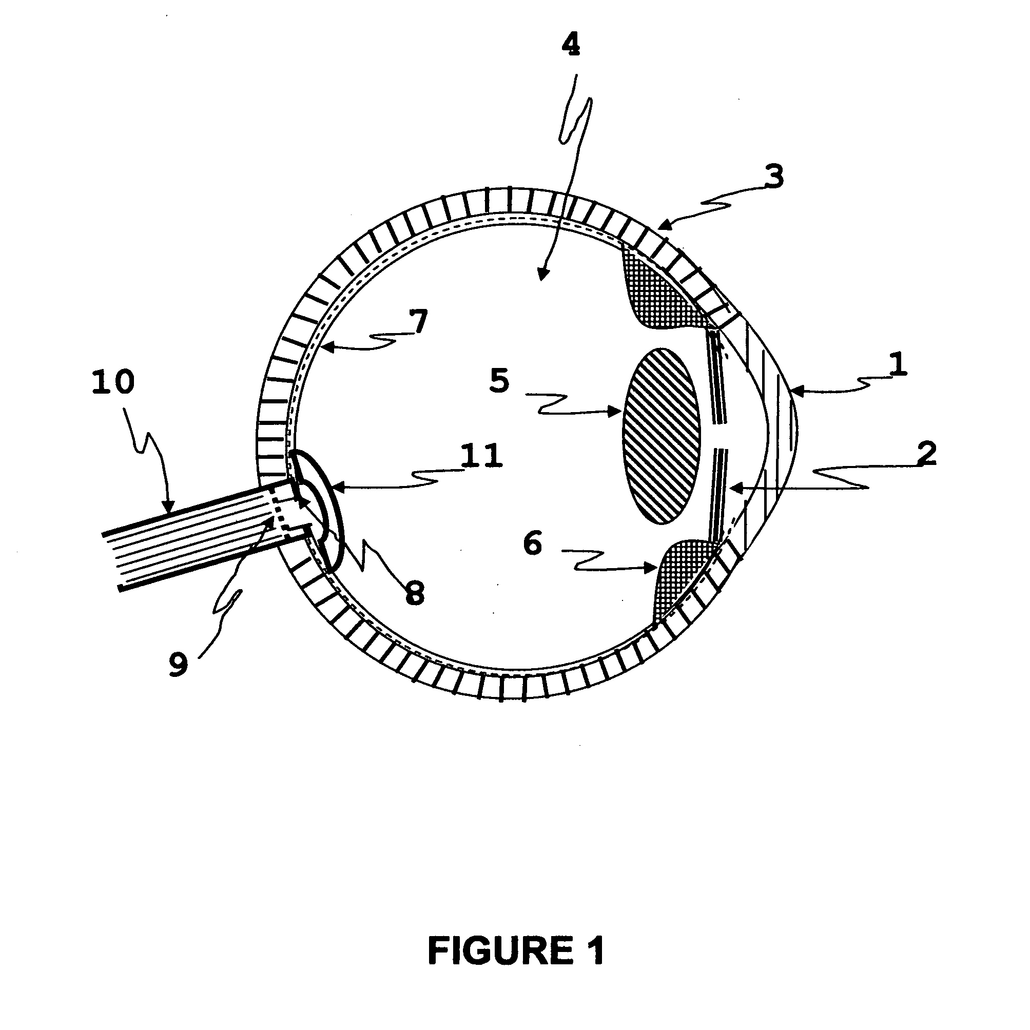 Apparatus and method for preventing glaucomatous optic neuropathy