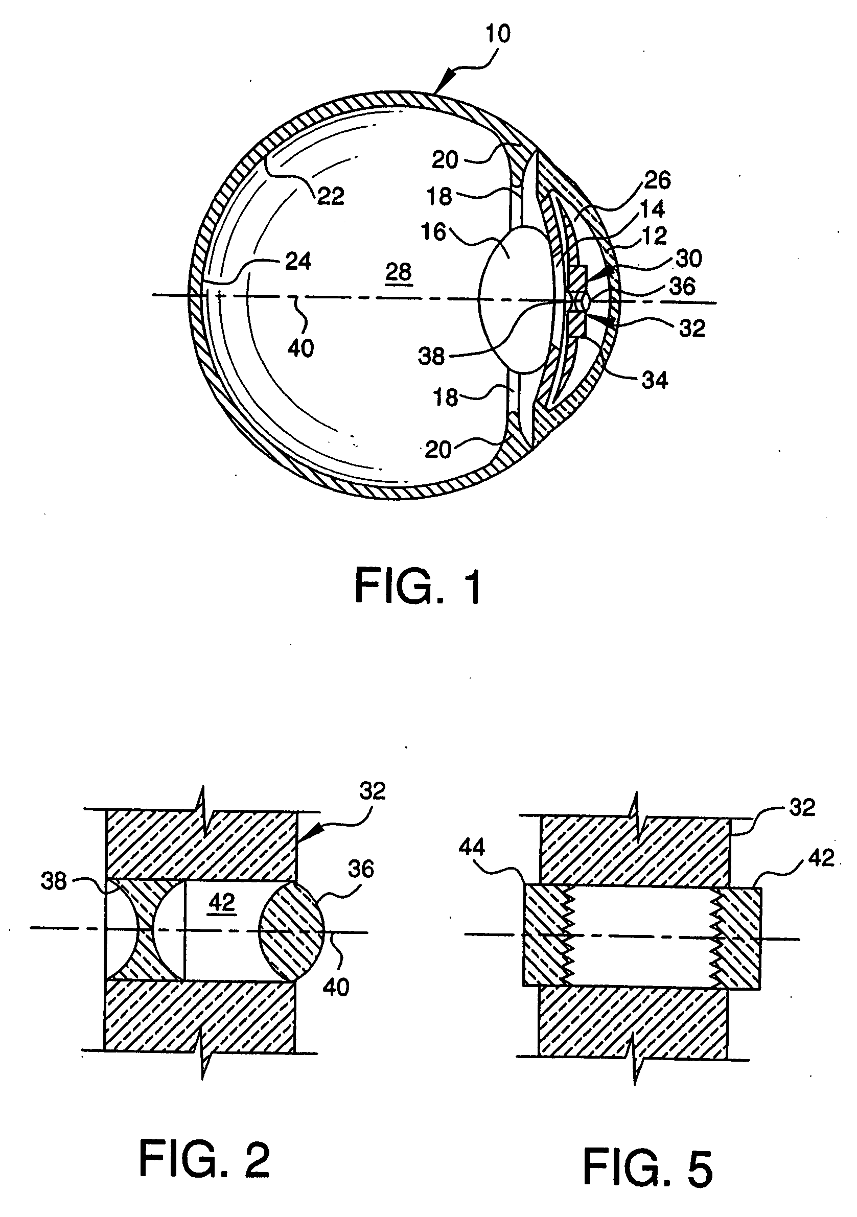 Bifocal intraocular telescope for low vision correction