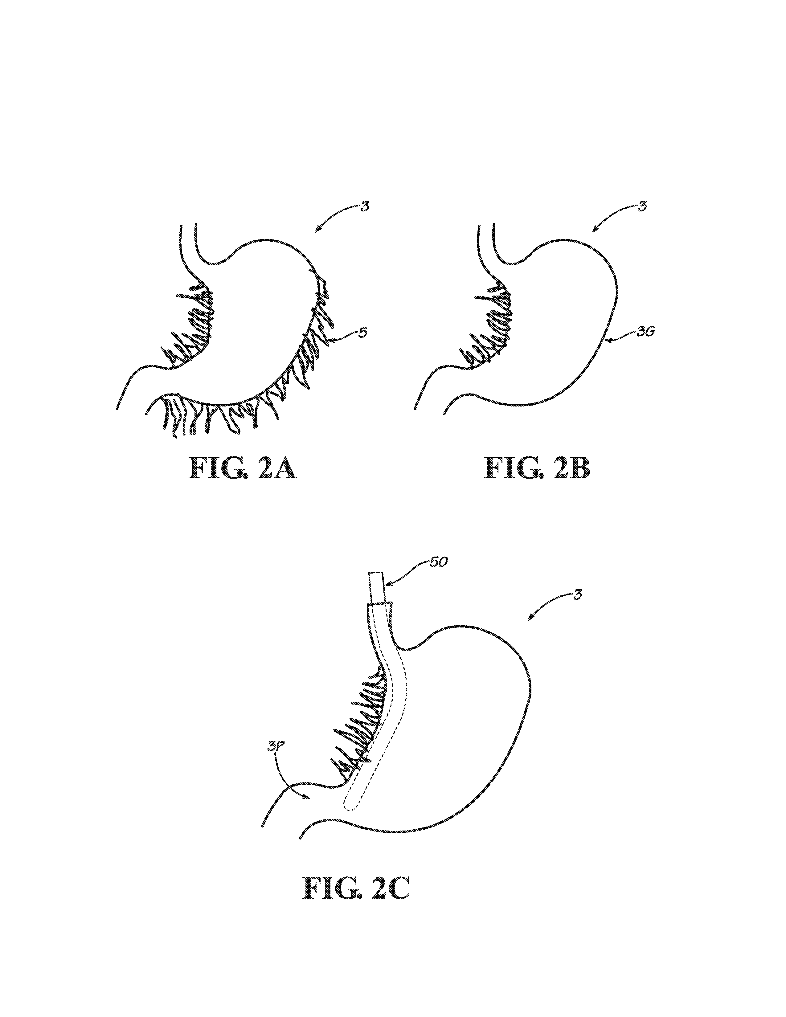 Methods, Instruments and Devices for Extragastric Reduction of Stomach Volume