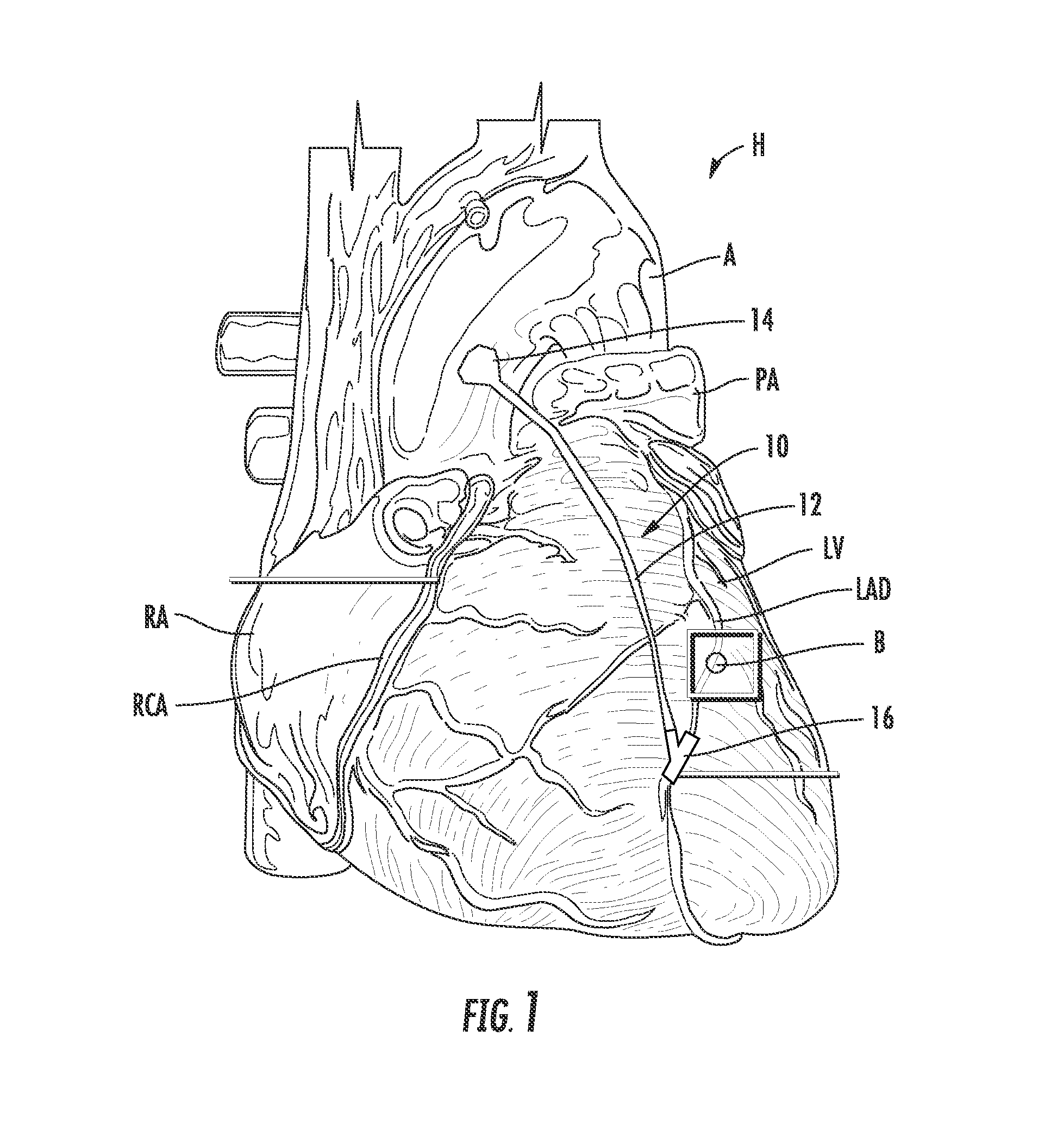 Method and apparatus for bypass graft