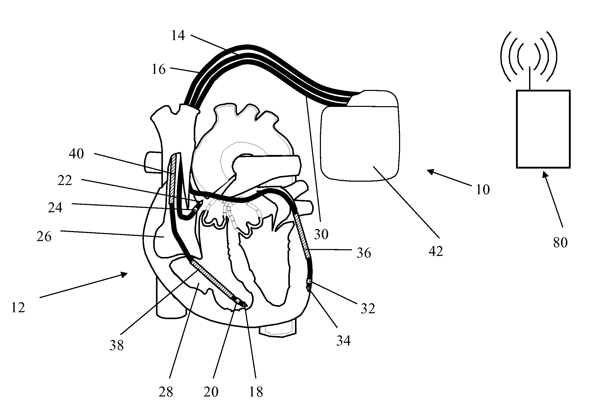 Apparatus and method to optimize pacing parameters