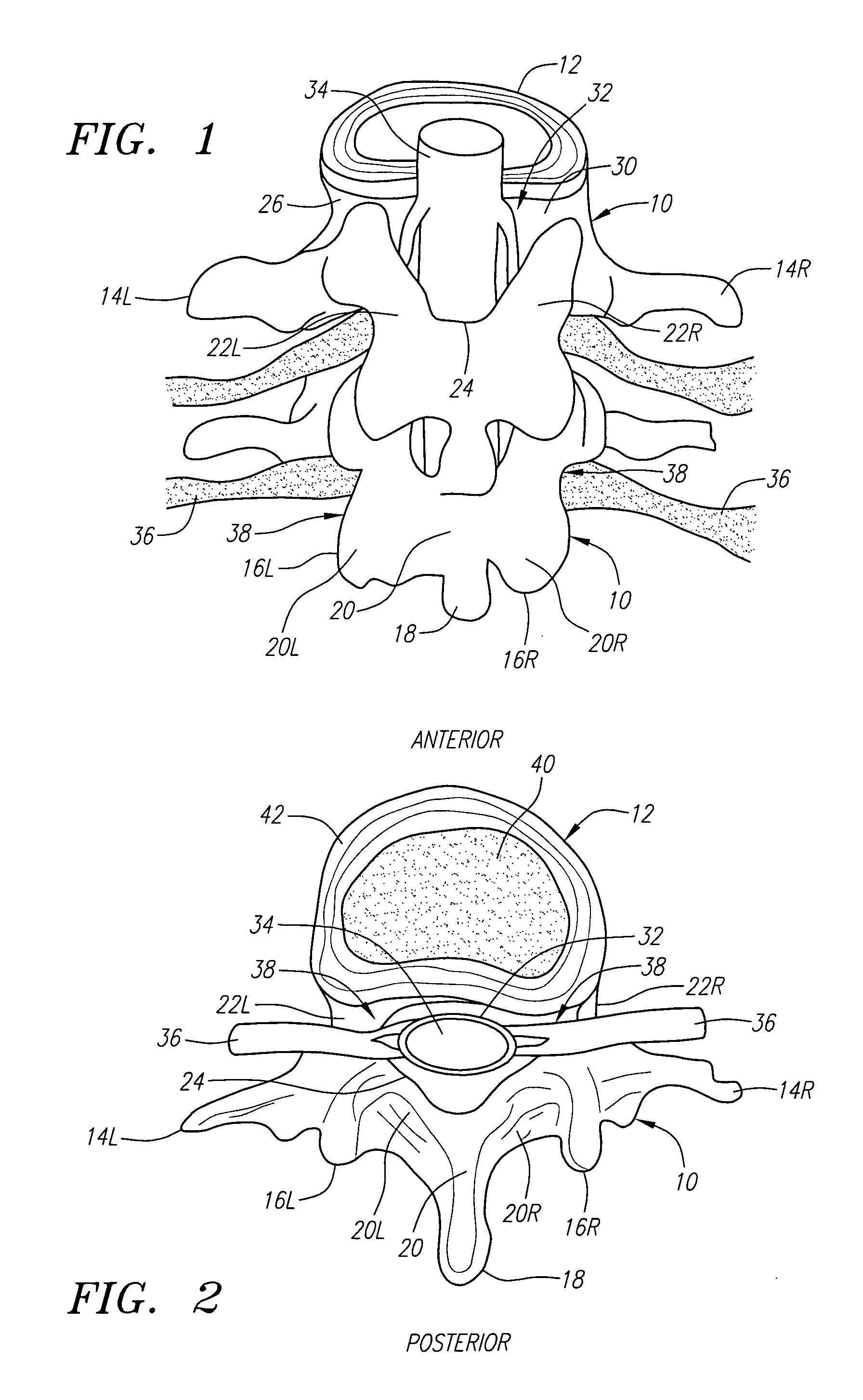 Radially adjustable tissue removal device