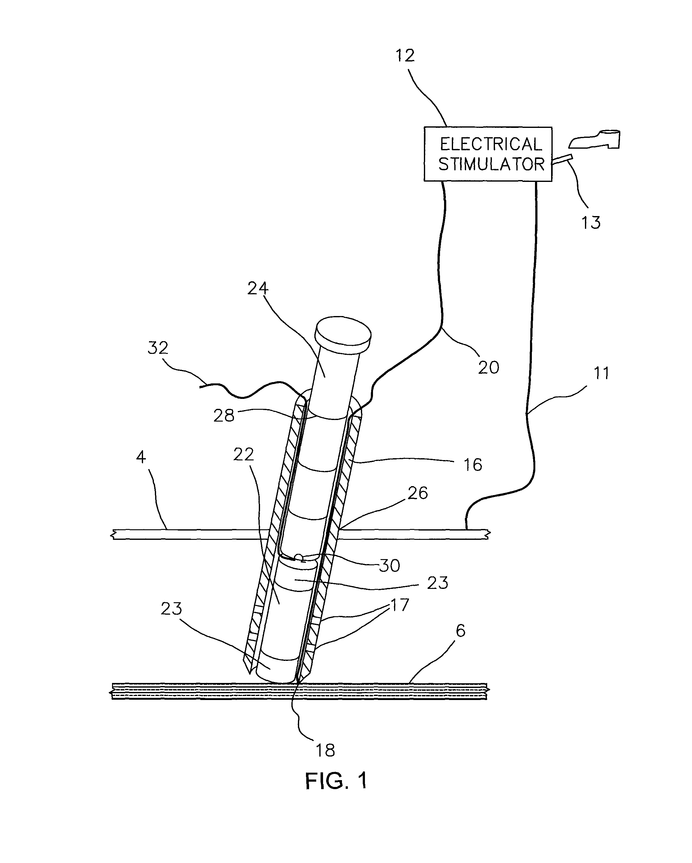 Method for removing surgically implanted devices