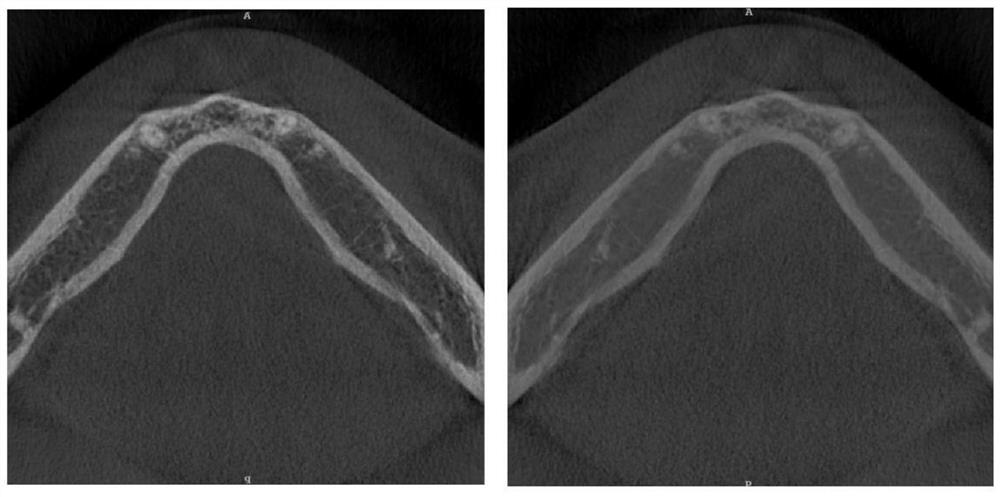 CBCT alveolar bone segmentation system and method based on deep learning