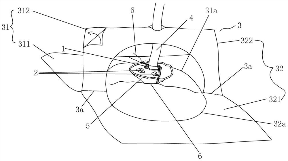 A new bridge-type fixation structure for umbilical arteriovenous catheterization in neonates