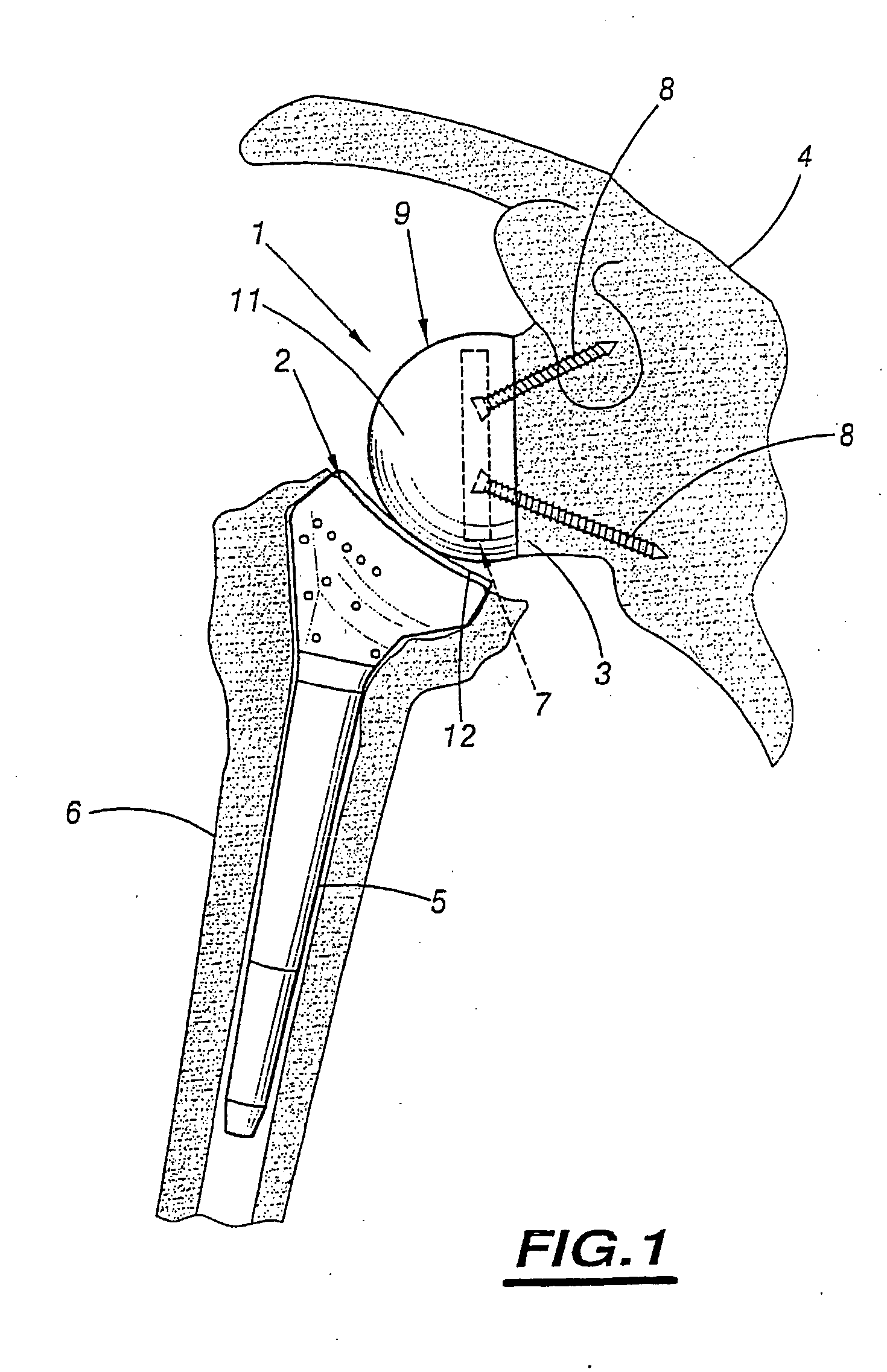 Shoulder prosthesis assembly