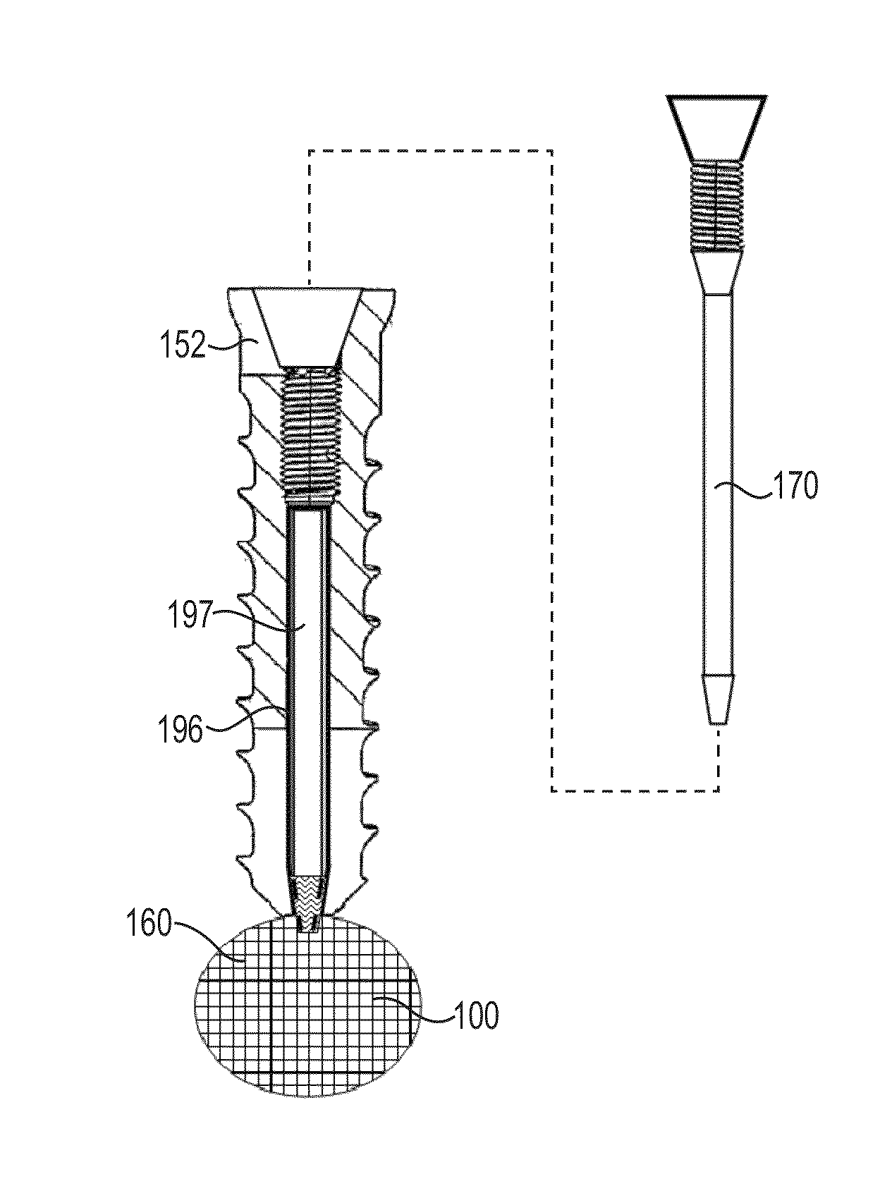 Fixation system for orthopedic devices