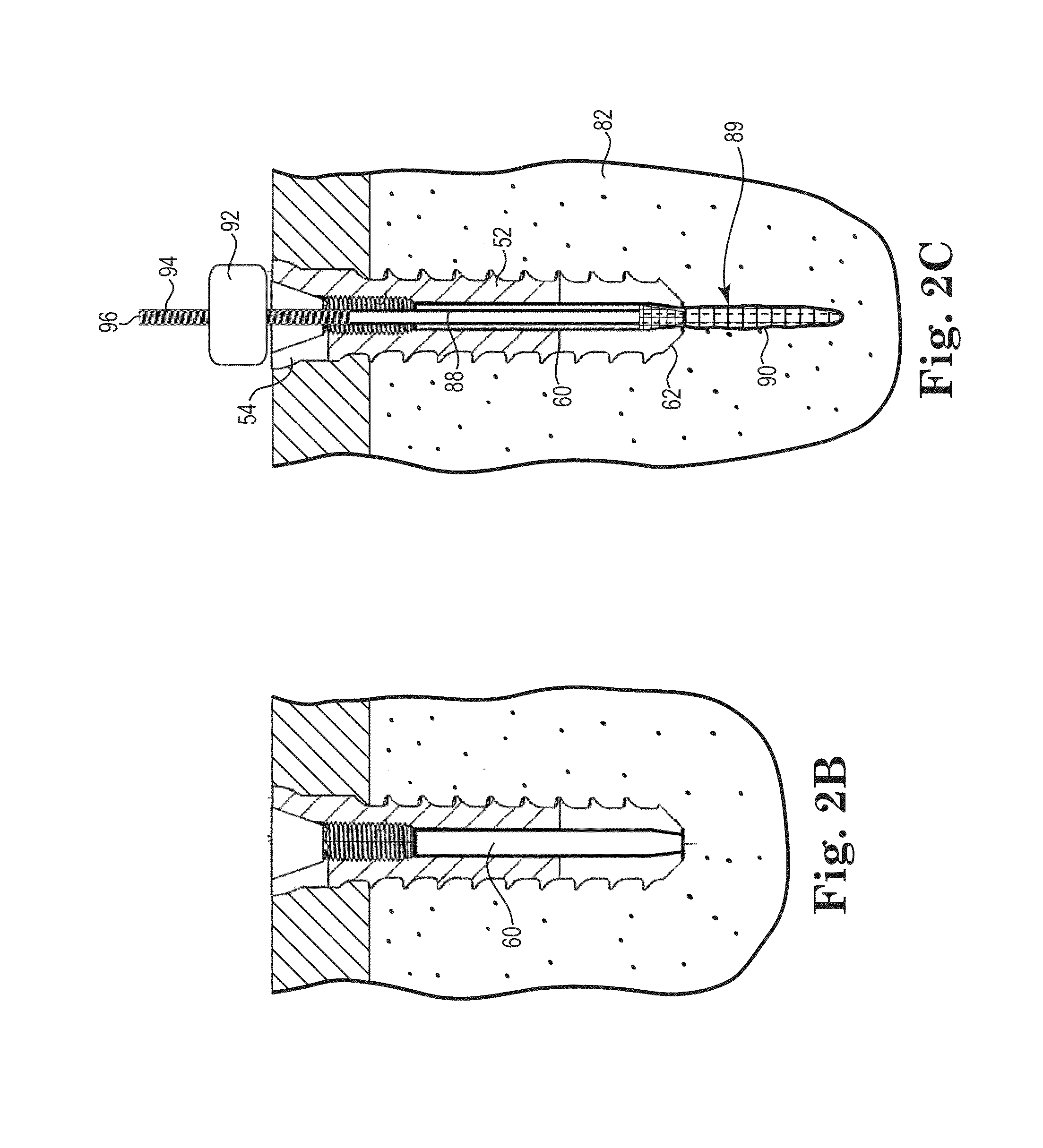 Fixation system for orthopedic devices