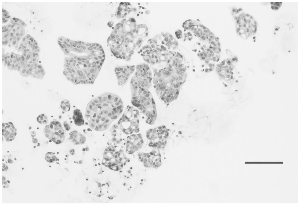 Culture medium for culturing primary cells of gynecological tumors