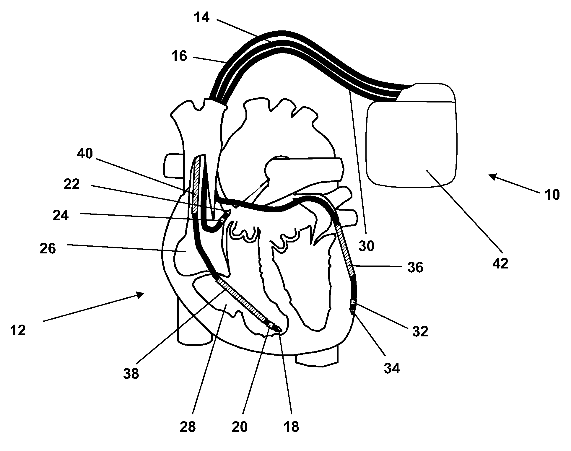 Implantable medical devices evaluating thorax impedance