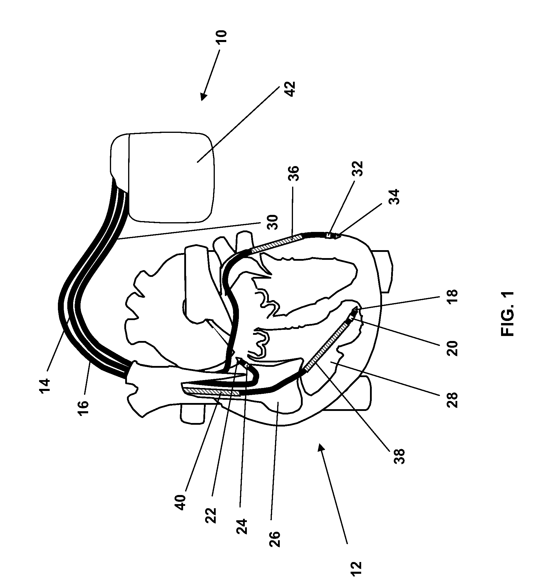 Implantable medical devices evaluating thorax impedance