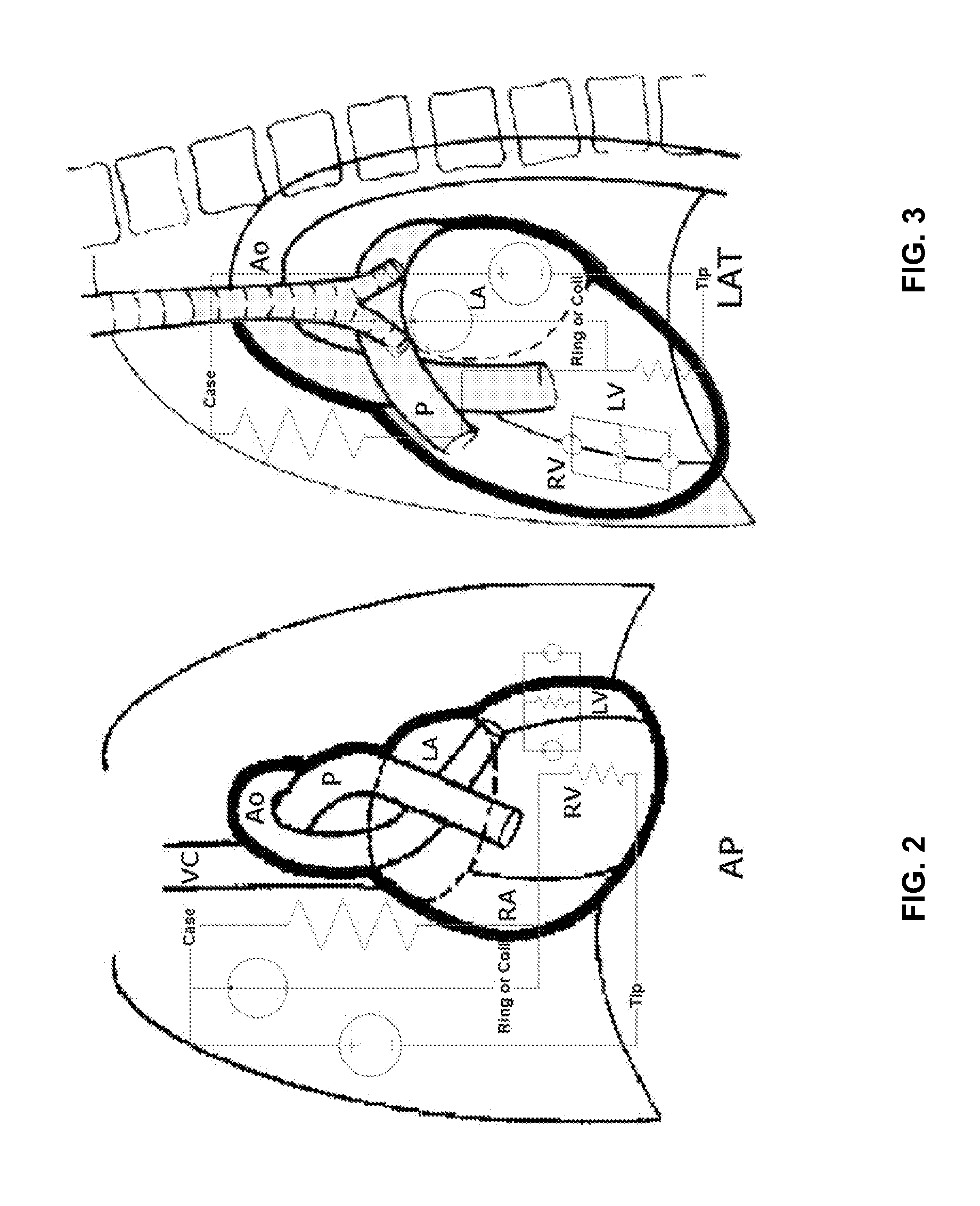 Implantable medical devices evaluating thorax impedance