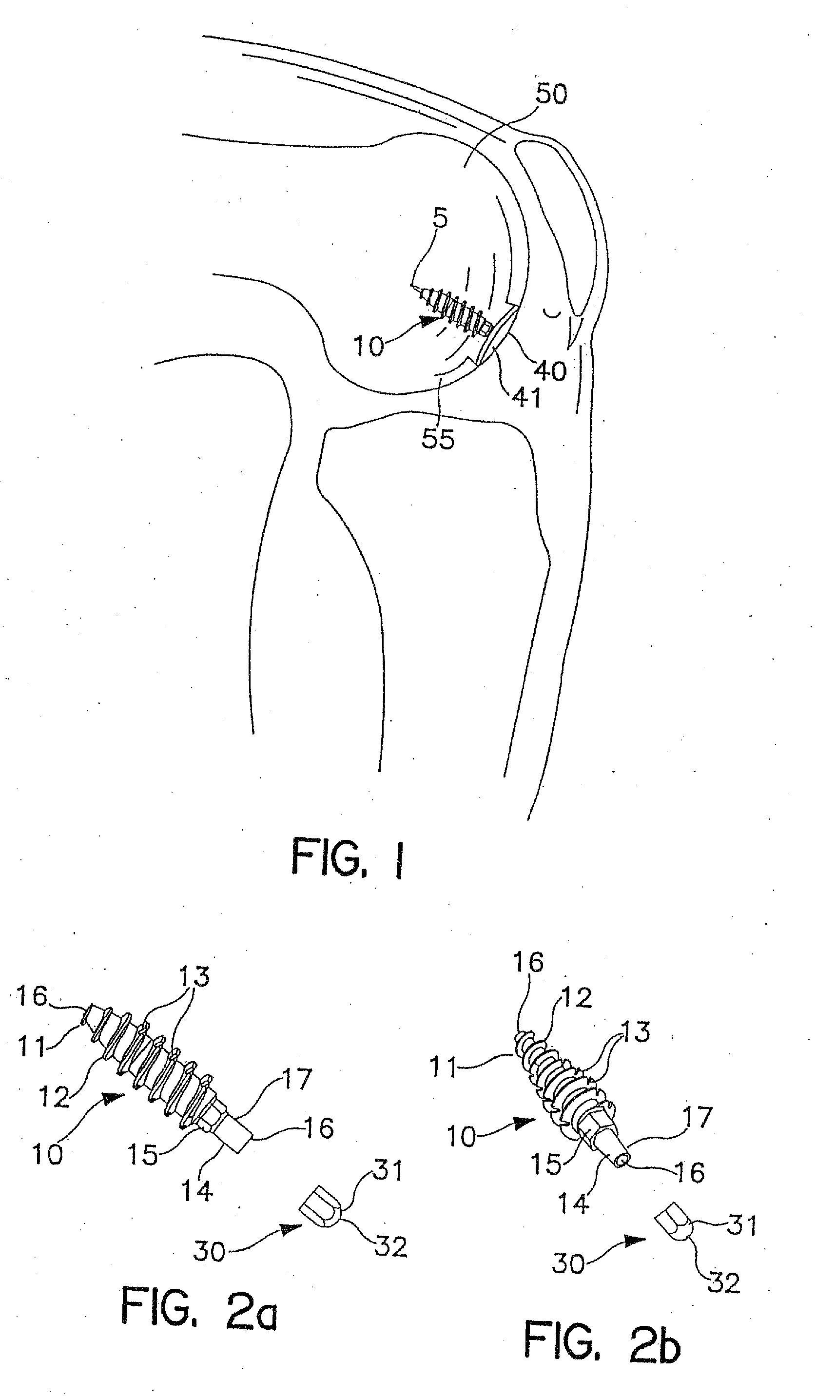 System and Method for Joint Resurface Repair