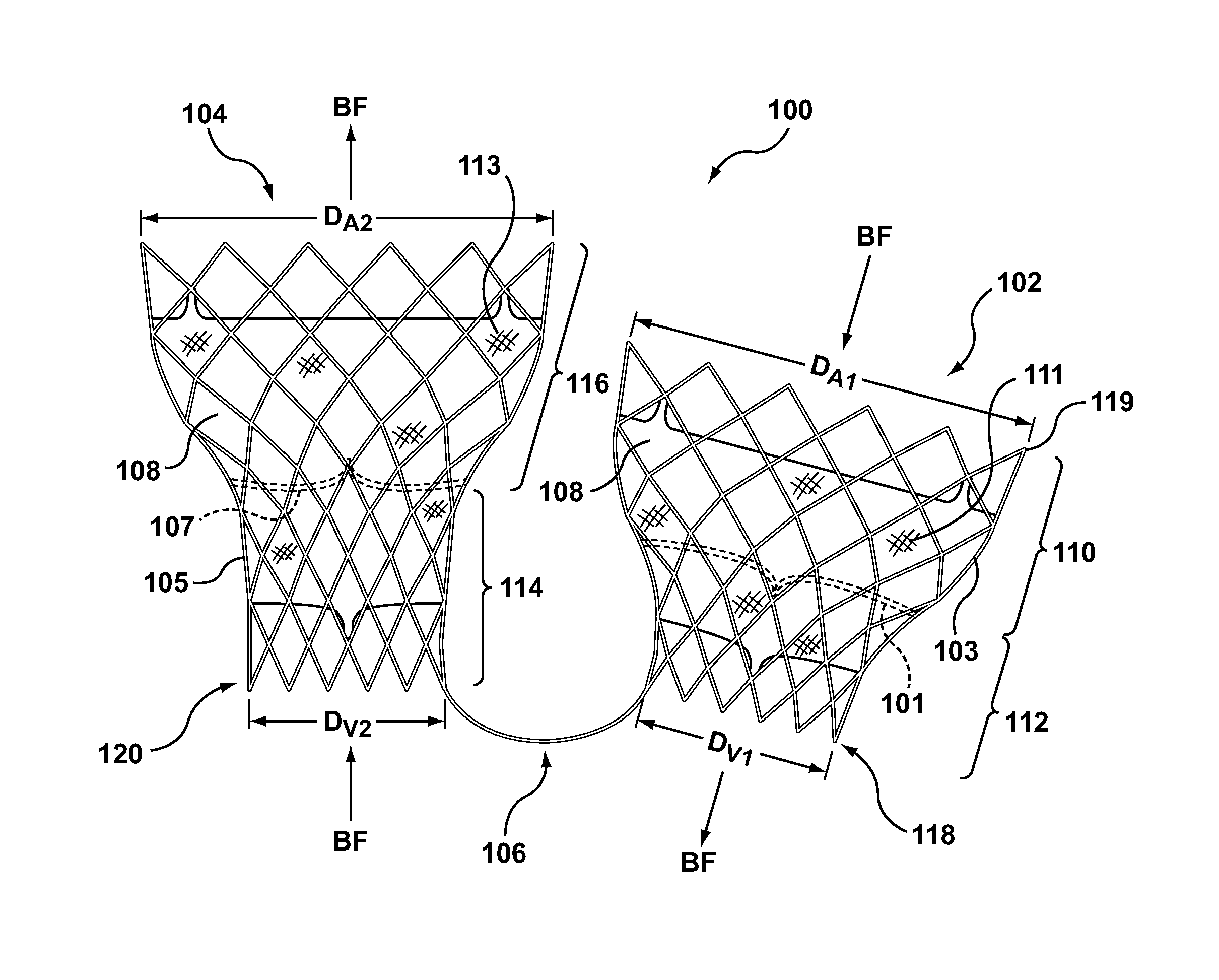 Dual valve prosthesis for transcatheter valve implantation