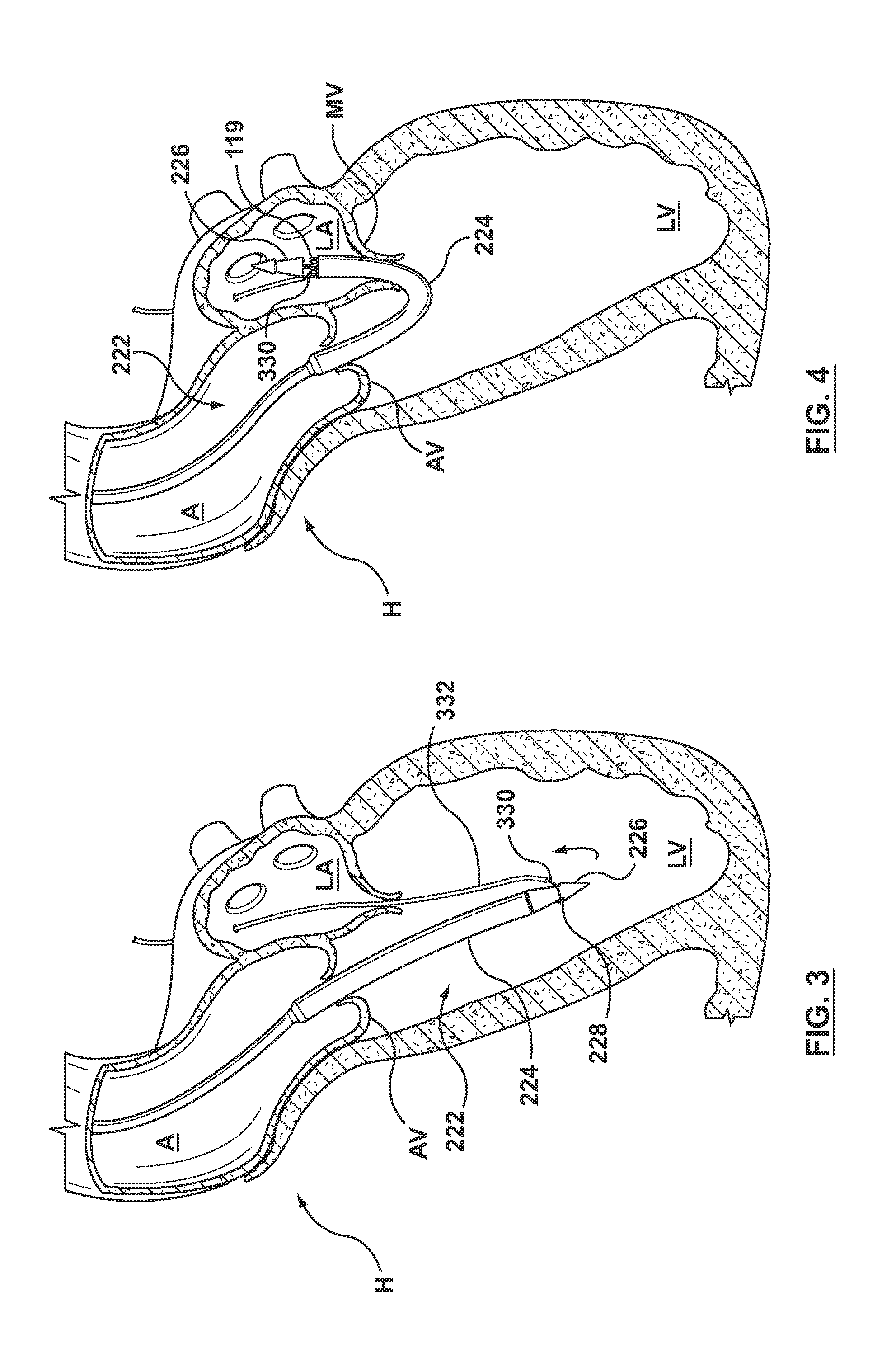 Dual valve prosthesis for transcatheter valve implantation