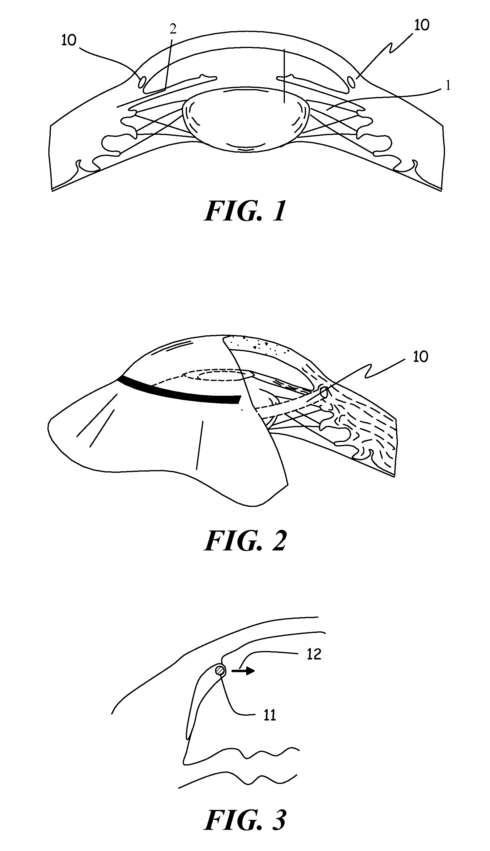 Ophthalmic implant for treatment of glaucoma