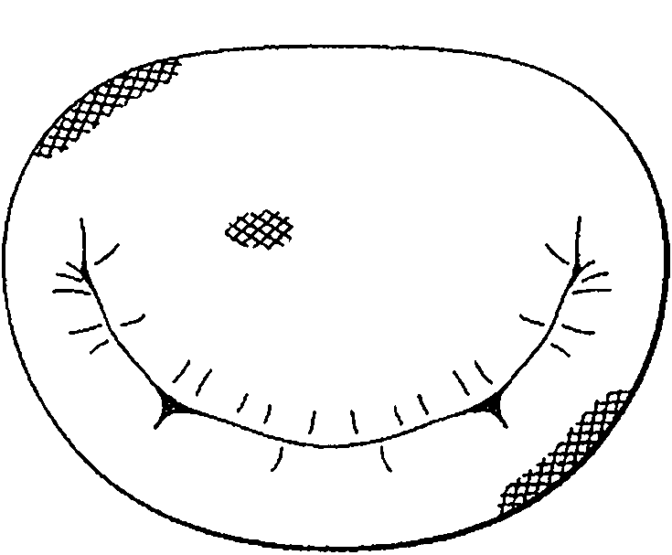 Degenerative valvular disease specific annuloplasty rings