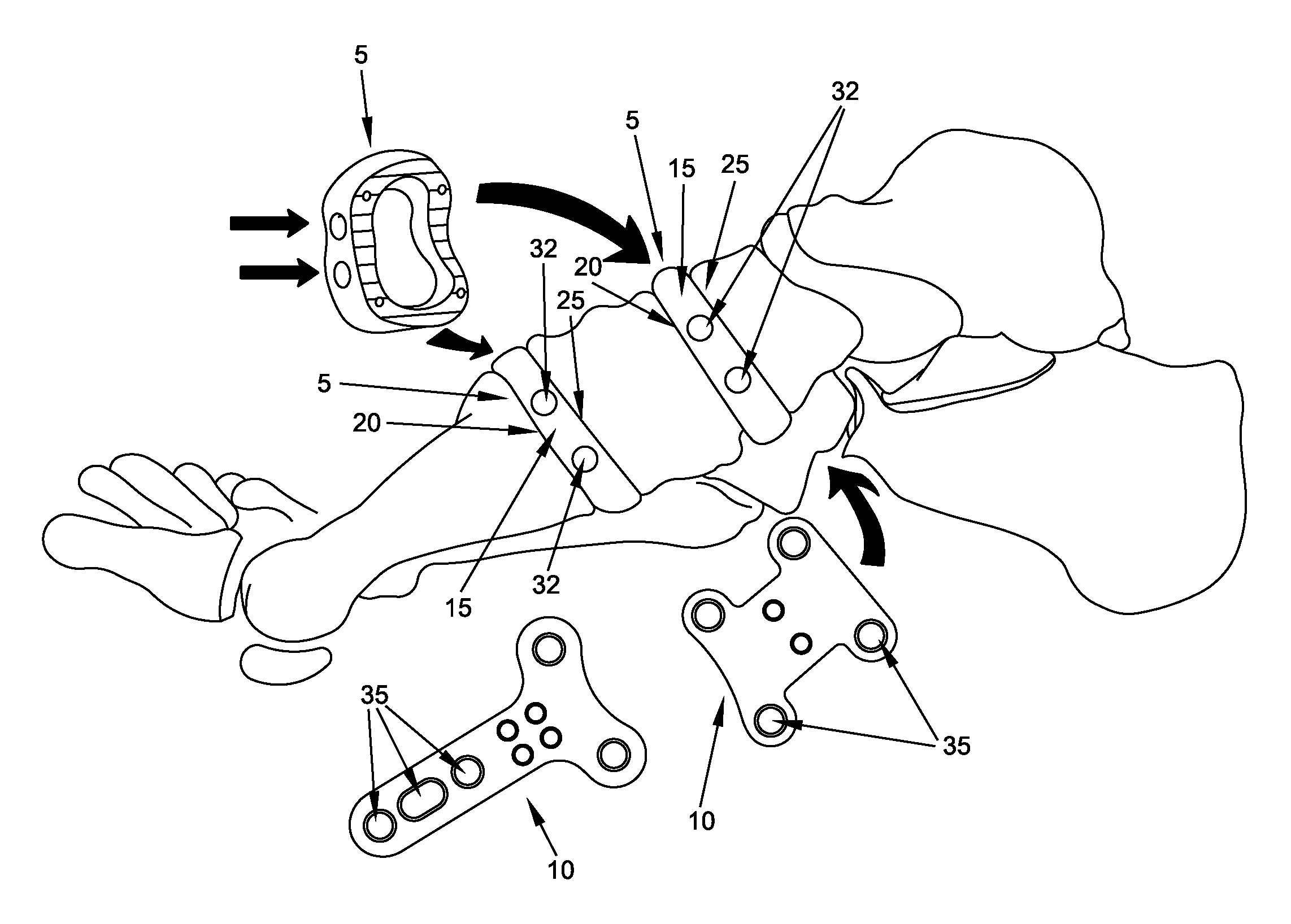 Method and apparatus for fusing the bones of a joint