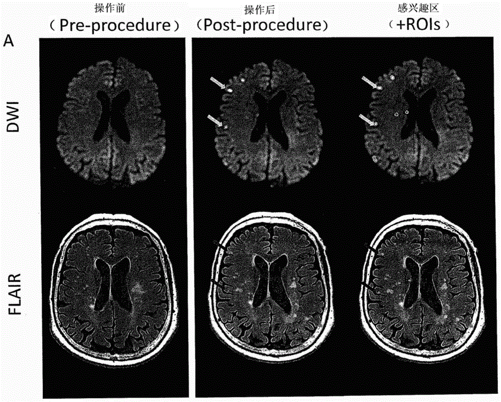 A treatment method for subarachnoid hemorrhage and local ischemia