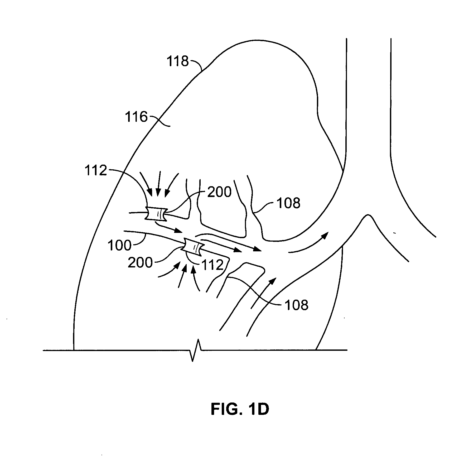 Methods and devices for maintaining surgically created channels in a body organ