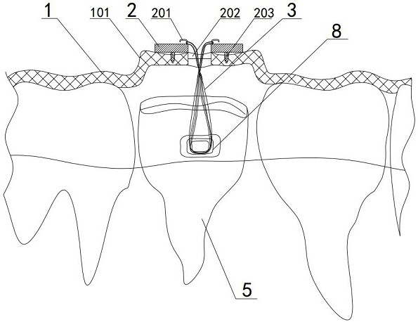 Tooth traction appliance