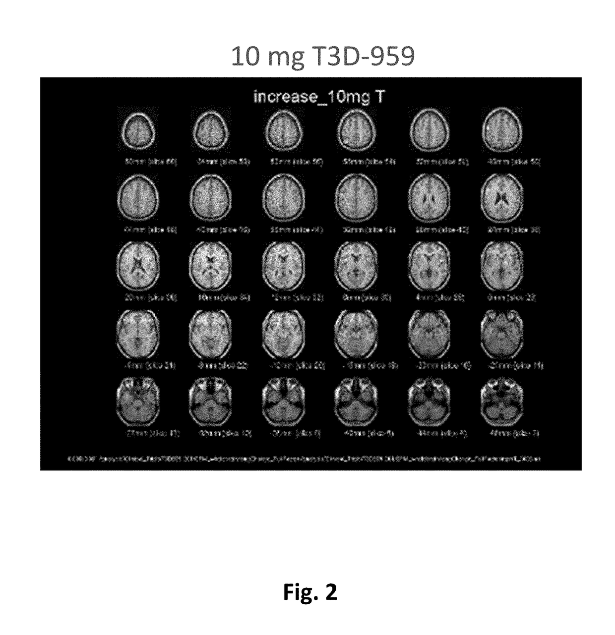 Methods of treating neurodegenerative diseases using indane acetic acid derivatives which penetrate the blood brain barrier