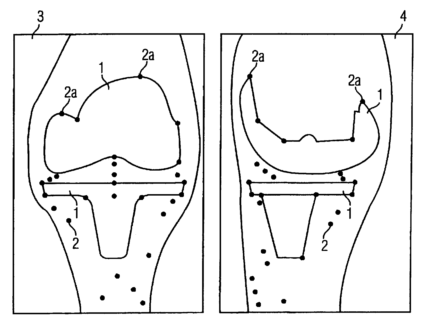 Method and x-ray system for detecting position changes of a medical implant